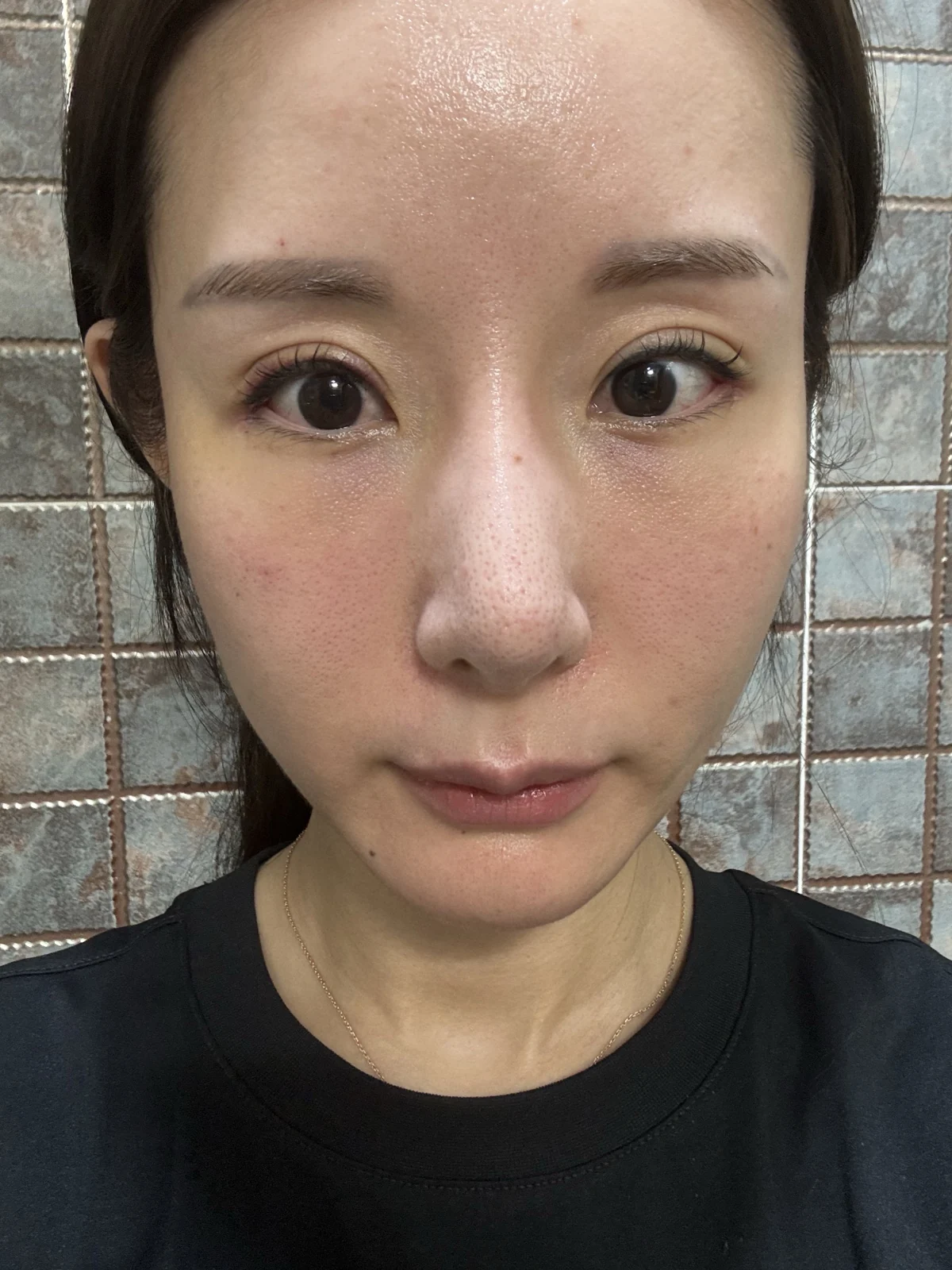 Wonder eye-corner surgery with a fuller eyelid crease: early recovery · Case 035 at Answer Plastic Surgery. Front view — 1 week, after stitch removal at Answer Plastic Surgery.