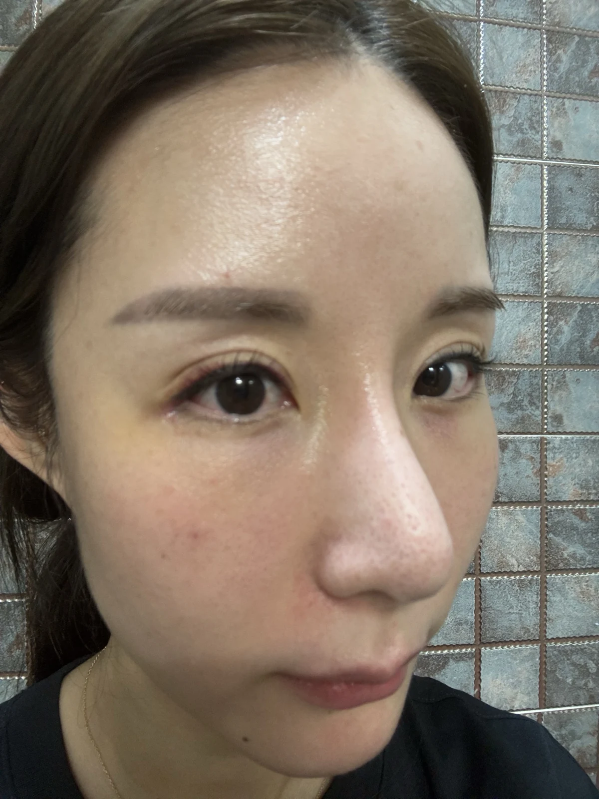 Wonder eye-corner surgery with a fuller eyelid crease: early recovery · Case 035 at Answer Plastic Surgery. Oblique close view — 1 week, after stitch removal at Answer Plastic Surgery.