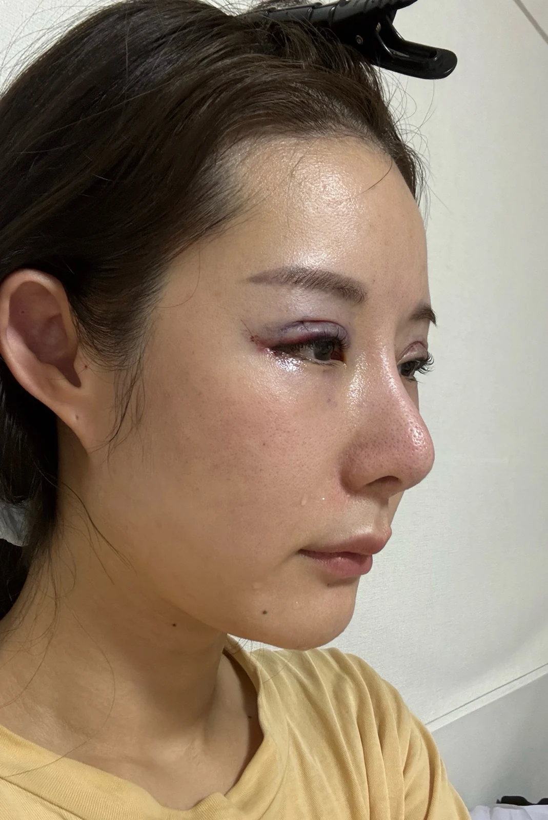 Wonder eye-corner surgery with a fuller eyelid crease: early recovery · Case 035 at Answer Plastic Surgery. Oblique view — surgery day at Answer Plastic Surgery.