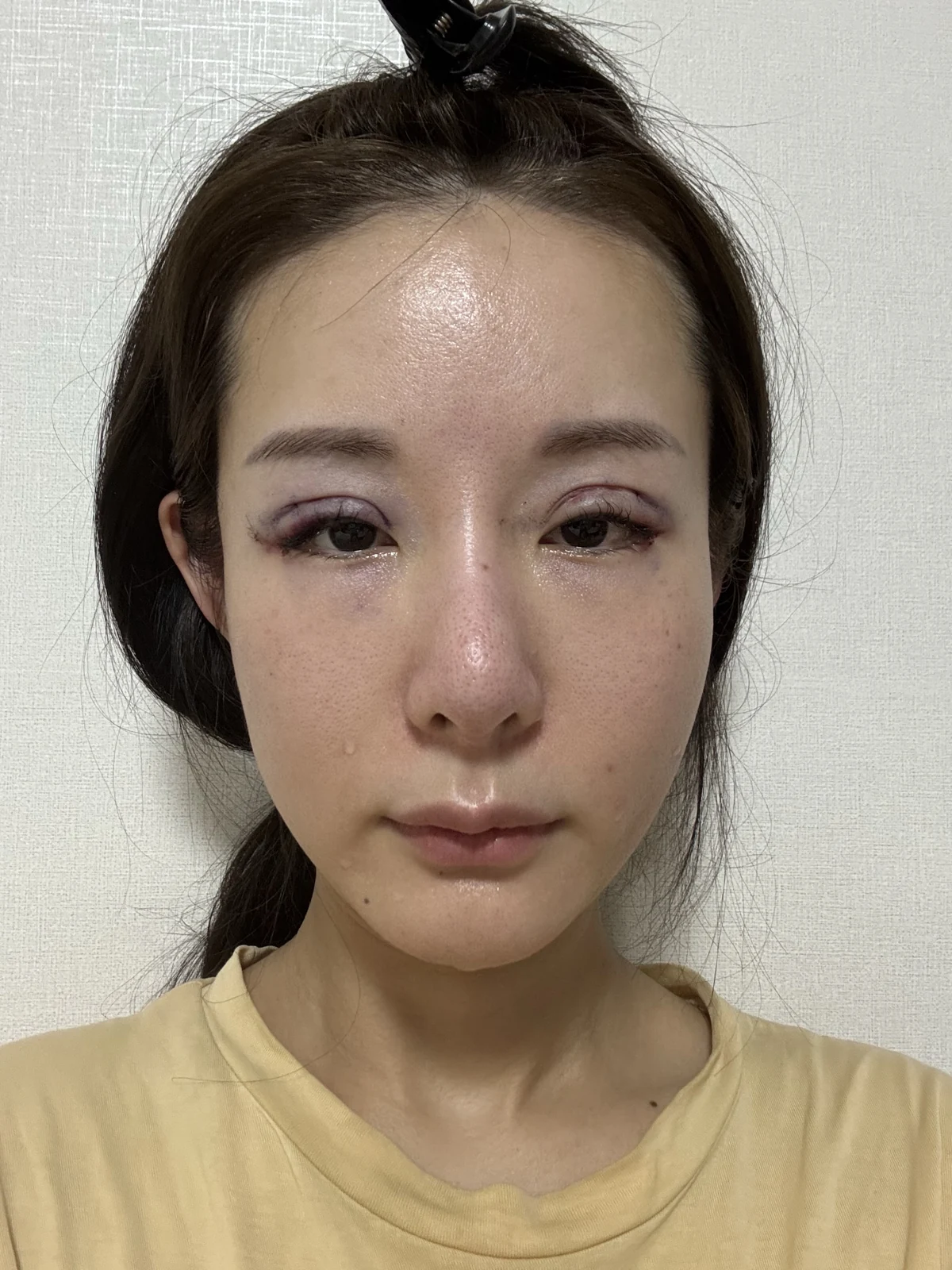 Wonder eye-corner surgery with a fuller eyelid crease: early recovery · Case 035 at Answer Plastic Surgery. Front view — surgery day at Answer Plastic Surgery.