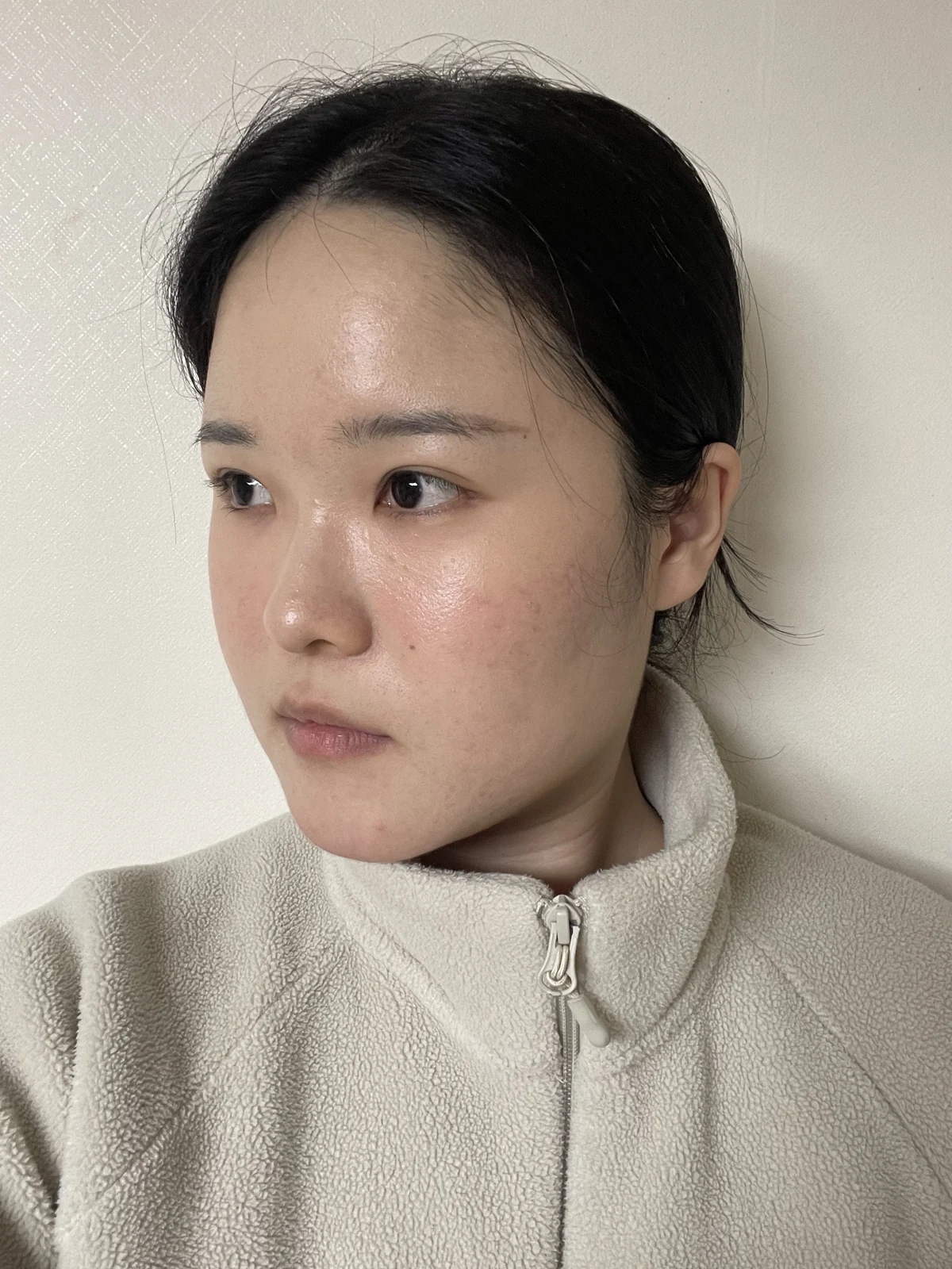 Wonder eye-corner surgery: recovery through one month · Case 036 at Answer Plastic Surgery. Oblique view — 1 month after surgery at Answer Plastic Surgery.
