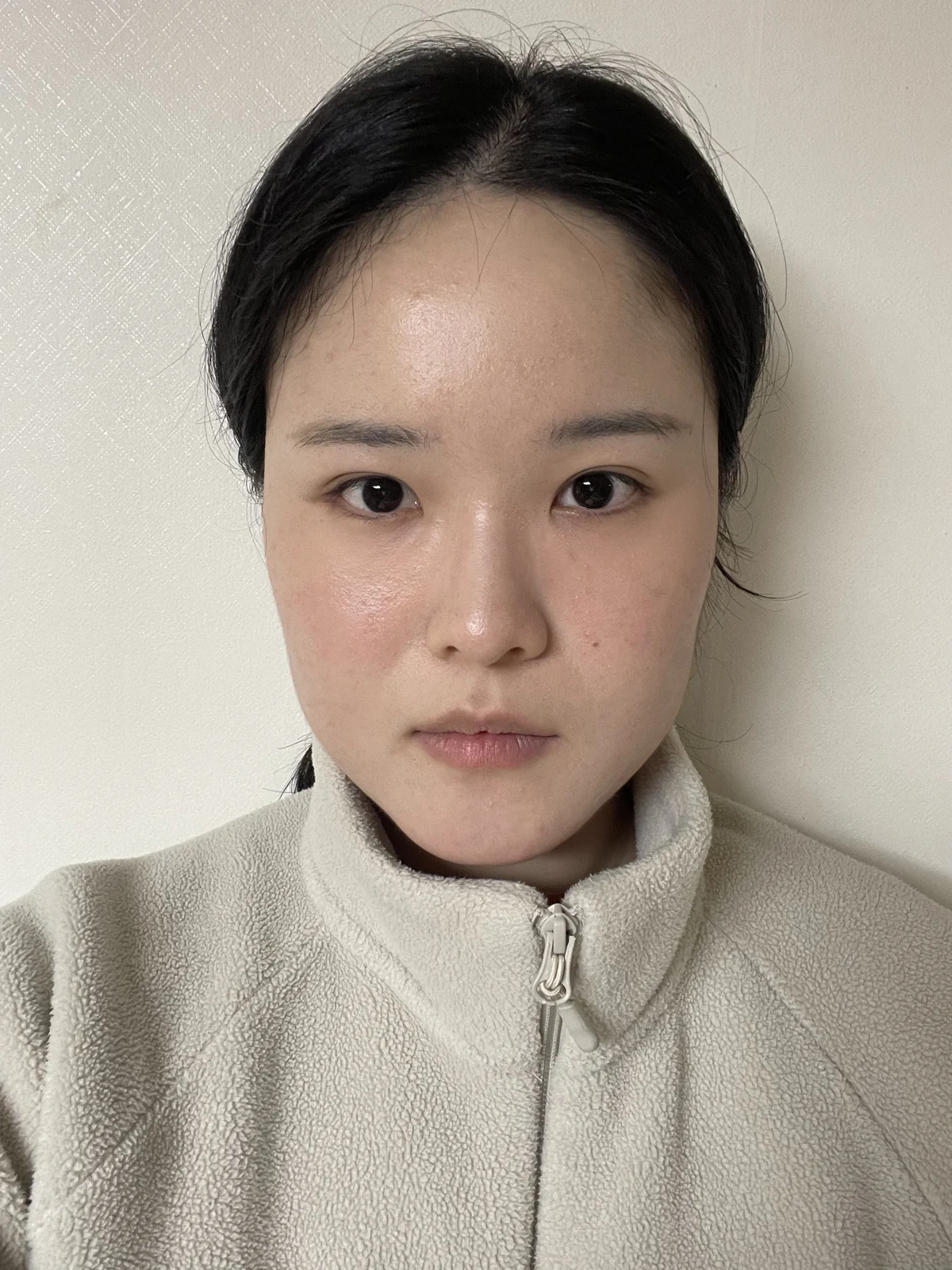 Wonder eye-corner surgery: recovery through one month · Case 036 at Answer Plastic Surgery. Front view — 1 month after surgery at Answer Plastic Surgery.