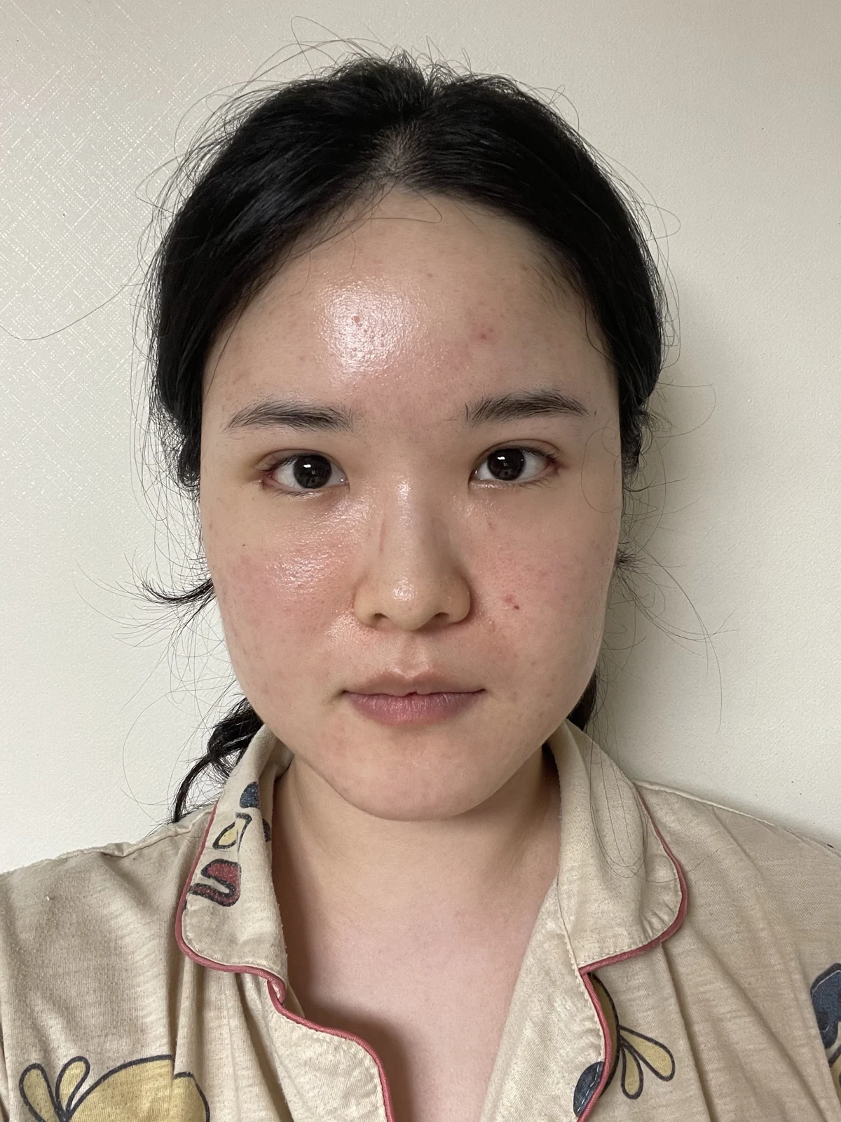 Wonder eye-corner surgery: recovery through one month · Case 036 at Answer Plastic Surgery. Front view — 1 week after surgery at Answer Plastic Surgery.