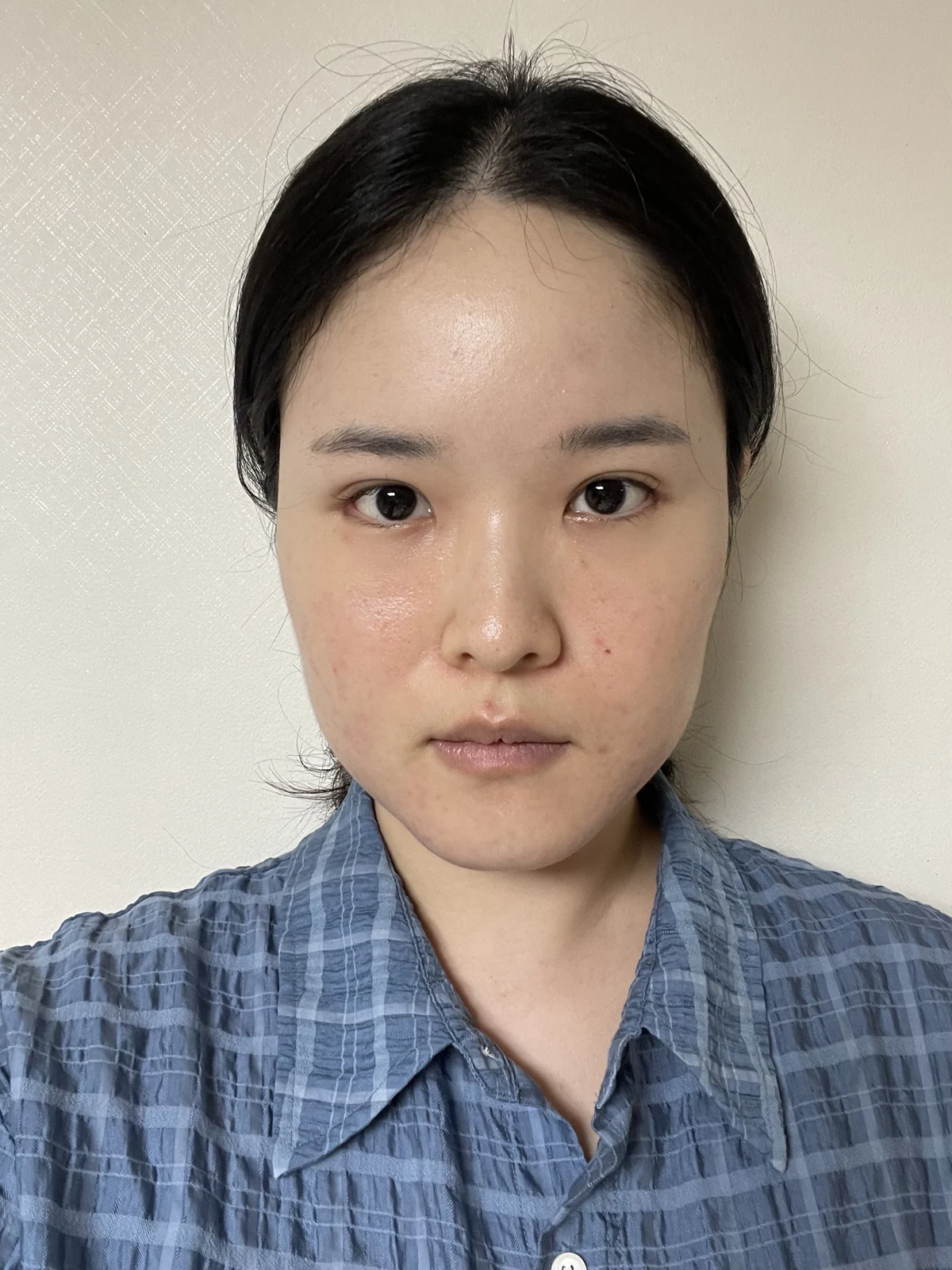 Wonder eye-corner surgery: recovery through one month · Case 036 at Answer Plastic Surgery. Front view — 2 weeks after surgery at Answer Plastic Surgery.