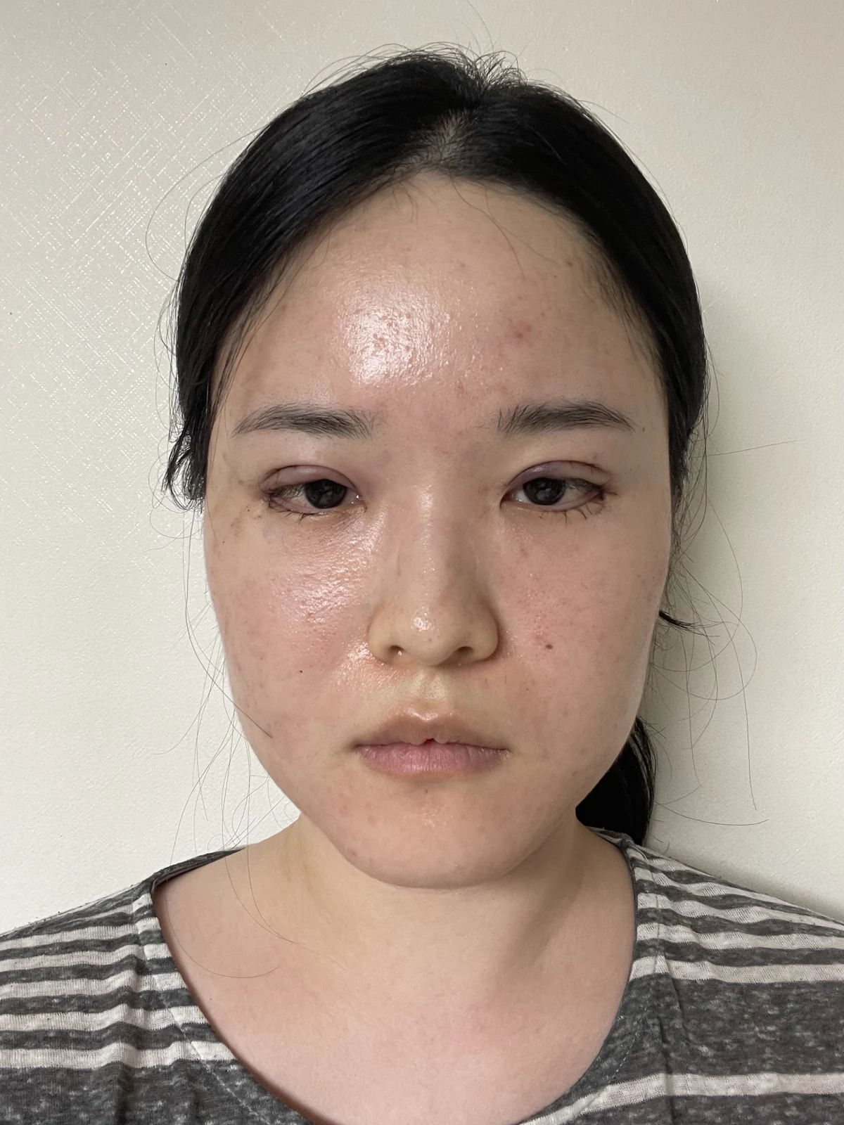 Wonder eye-corner surgery: recovery through one month · Case 036 at Answer Plastic Surgery. Front view — surgery day at Answer Plastic Surgery.