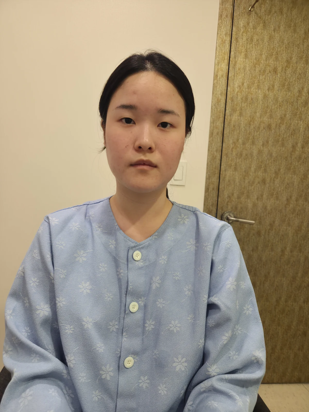 Wonder eye-corner surgery: recovery through one month · Case 036 at Answer Plastic Surgery. Front view — before at Answer Plastic Surgery.