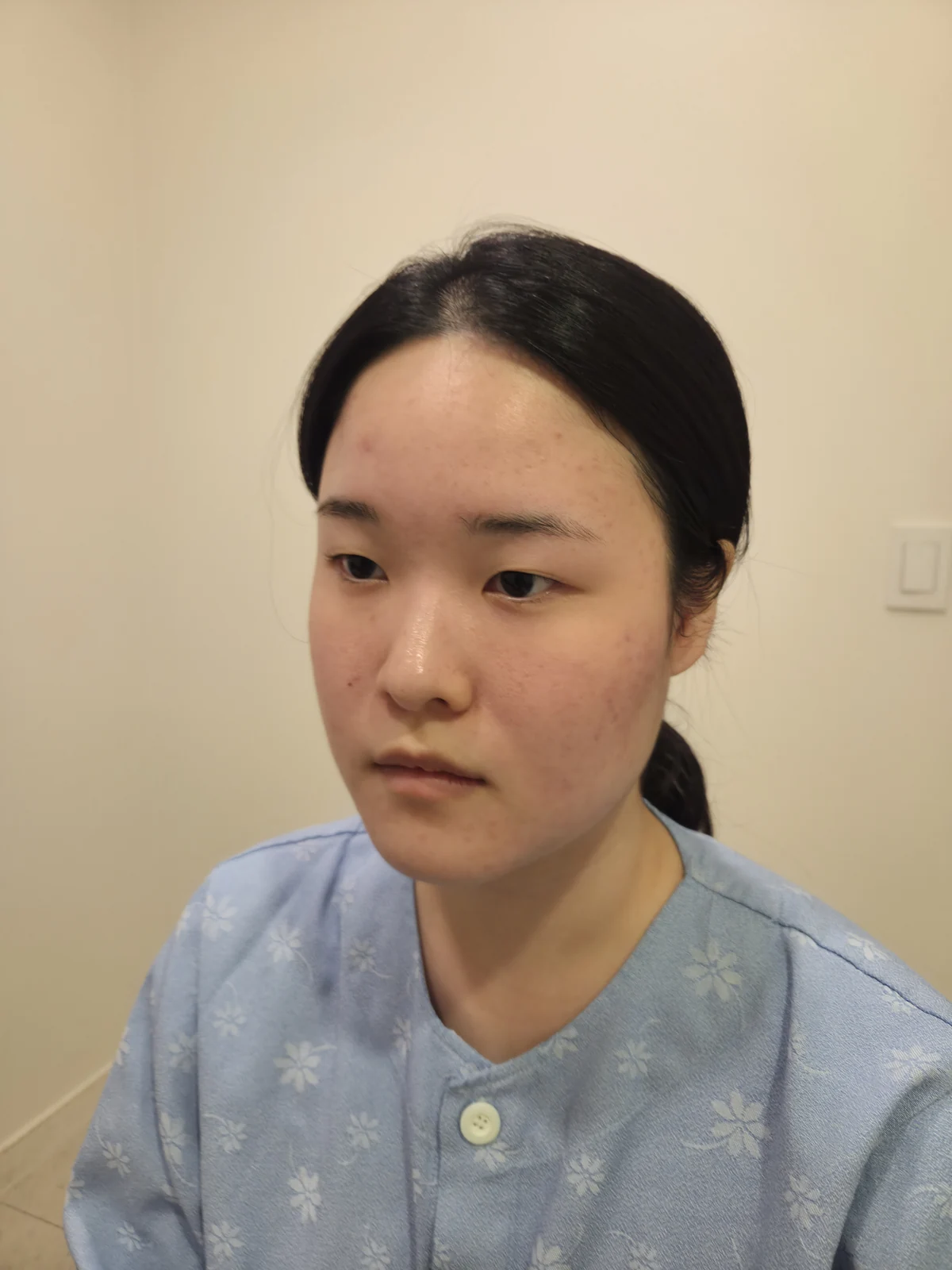 Wonder eye-corner surgery: recovery through one month · Case 036 at Answer Plastic Surgery. Oblique view — before at Answer Plastic Surgery.