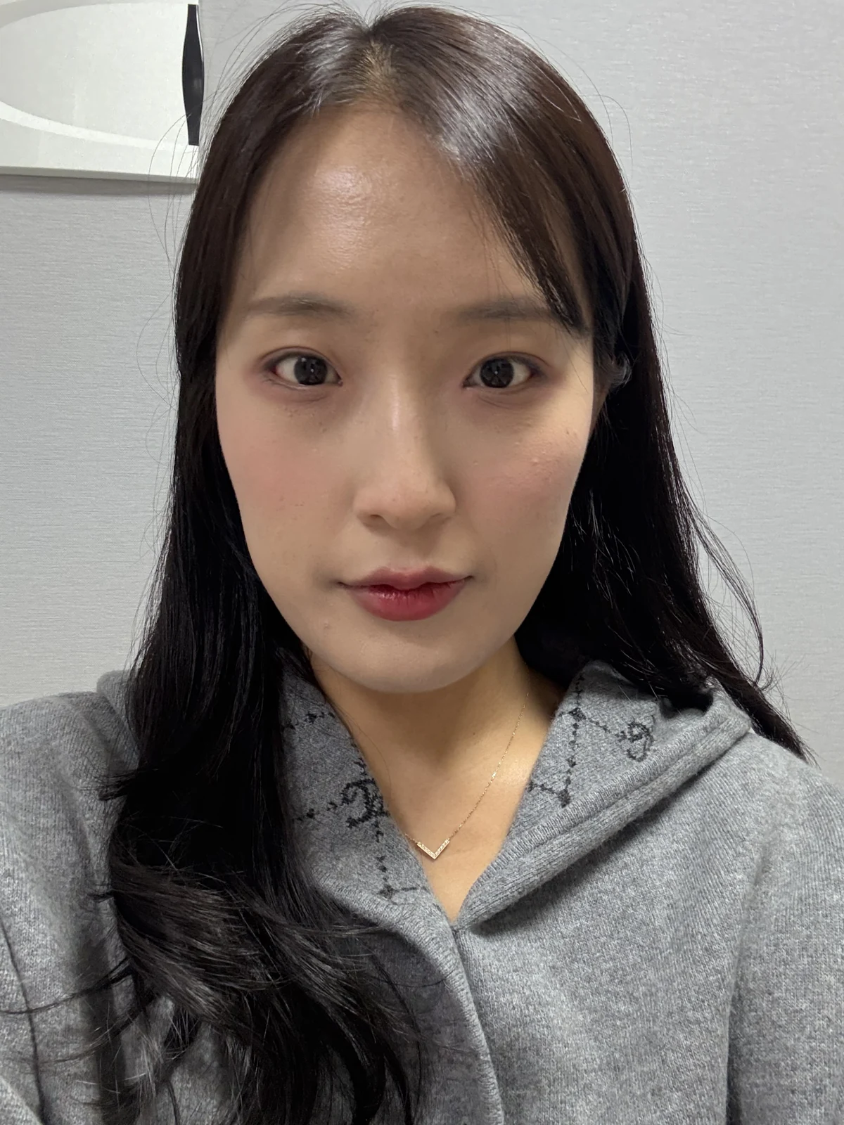 Inner and outer eye-corner surgery: a three-month photo diary · Case 037 at Answer Plastic Surgery. Front view — 1 month after surgery at Answer Plastic Surgery.