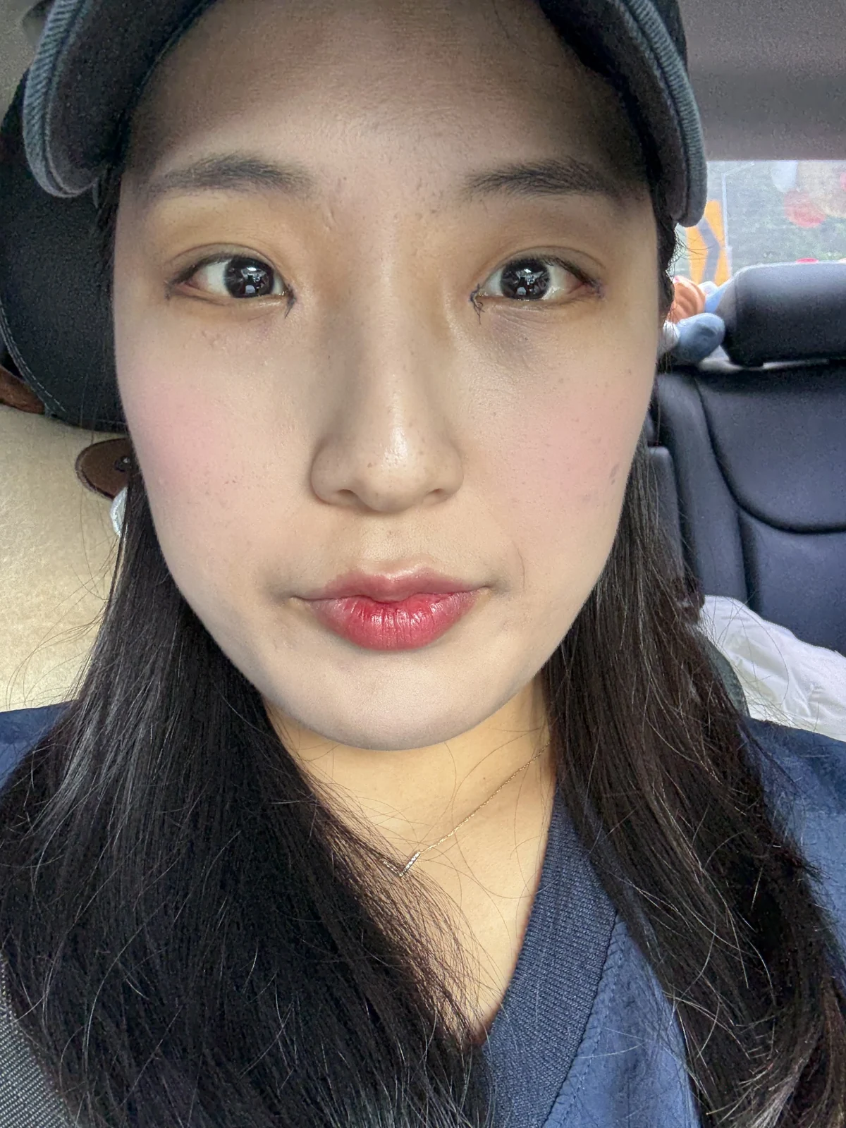 Inner and outer eye-corner surgery: a three-month photo diary · Case 037 at Answer Plastic Surgery. Front view — 1 week, before stitch removal at Answer Plastic Surgery.