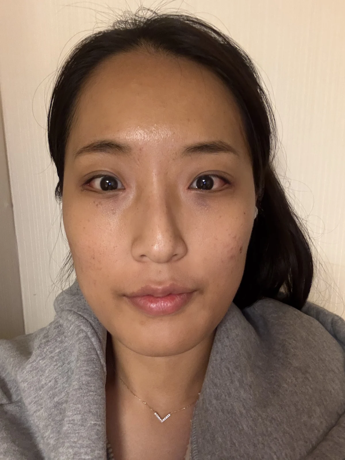Inner and outer eye-corner surgery: a three-month photo diary · Case 037 at Answer Plastic Surgery. Front view — 1 week, after stitch removal at Answer Plastic Surgery.