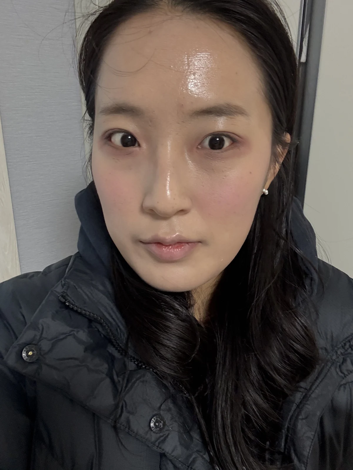 Inner and outer eye-corner surgery: a three-month photo diary · Case 037 at Answer Plastic Surgery. Front view — 2 months after surgery at Answer Plastic Surgery.