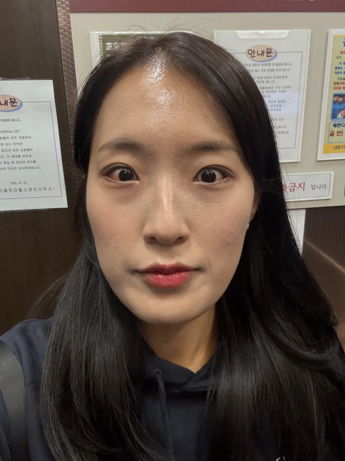 Inner and outer eye-corner surgery: a three-month photo diary · Case 037 at Answer Plastic Surgery. Front view — 2 weeks after surgery at Answer Plastic Surgery.