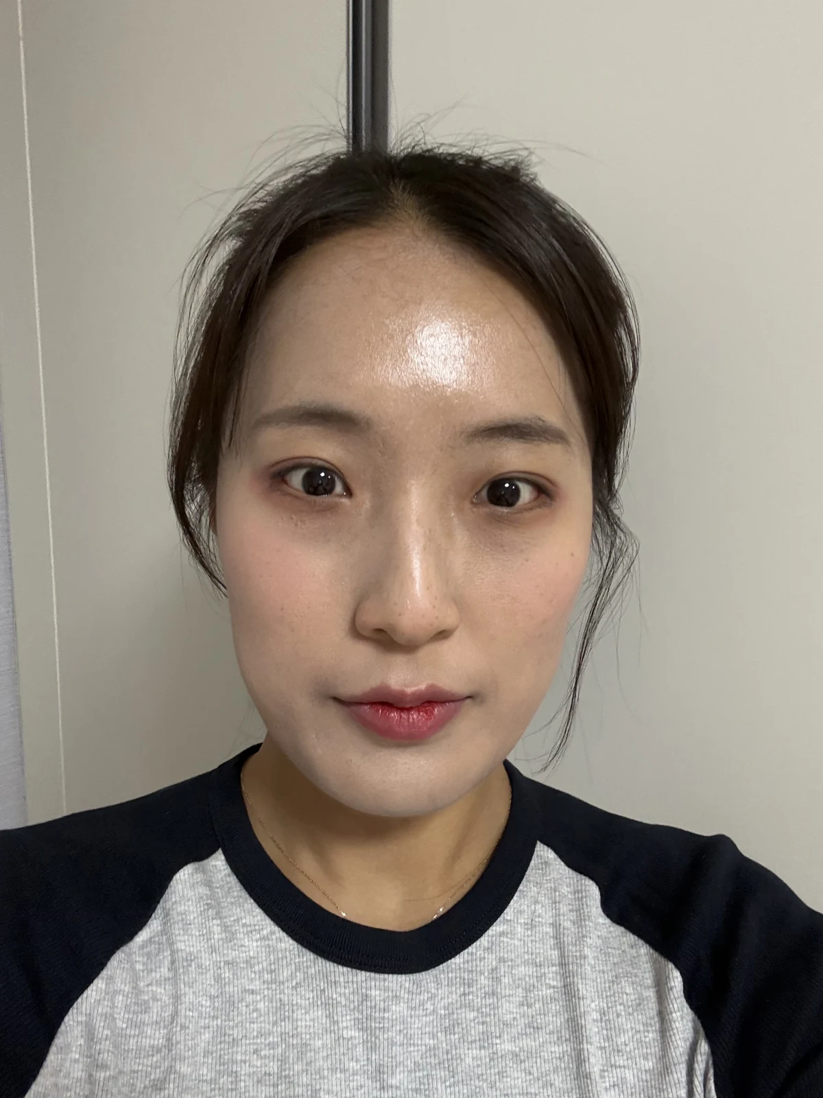 Inner and outer eye-corner surgery: a three-month photo diary · Case 037 at Answer Plastic Surgery. Front view — 3 months after surgery at Answer Plastic Surgery.