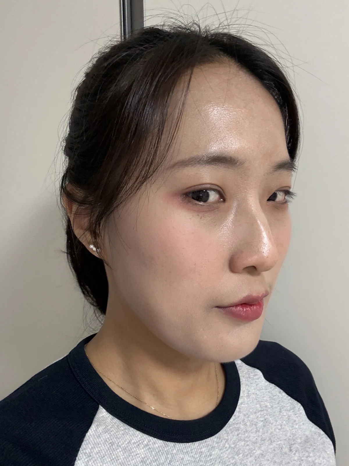 Inner and outer eye-corner surgery: a three-month photo diary · Case 037 at Answer Plastic Surgery. Oblique view — 3 months after surgery at Answer Plastic Surgery.