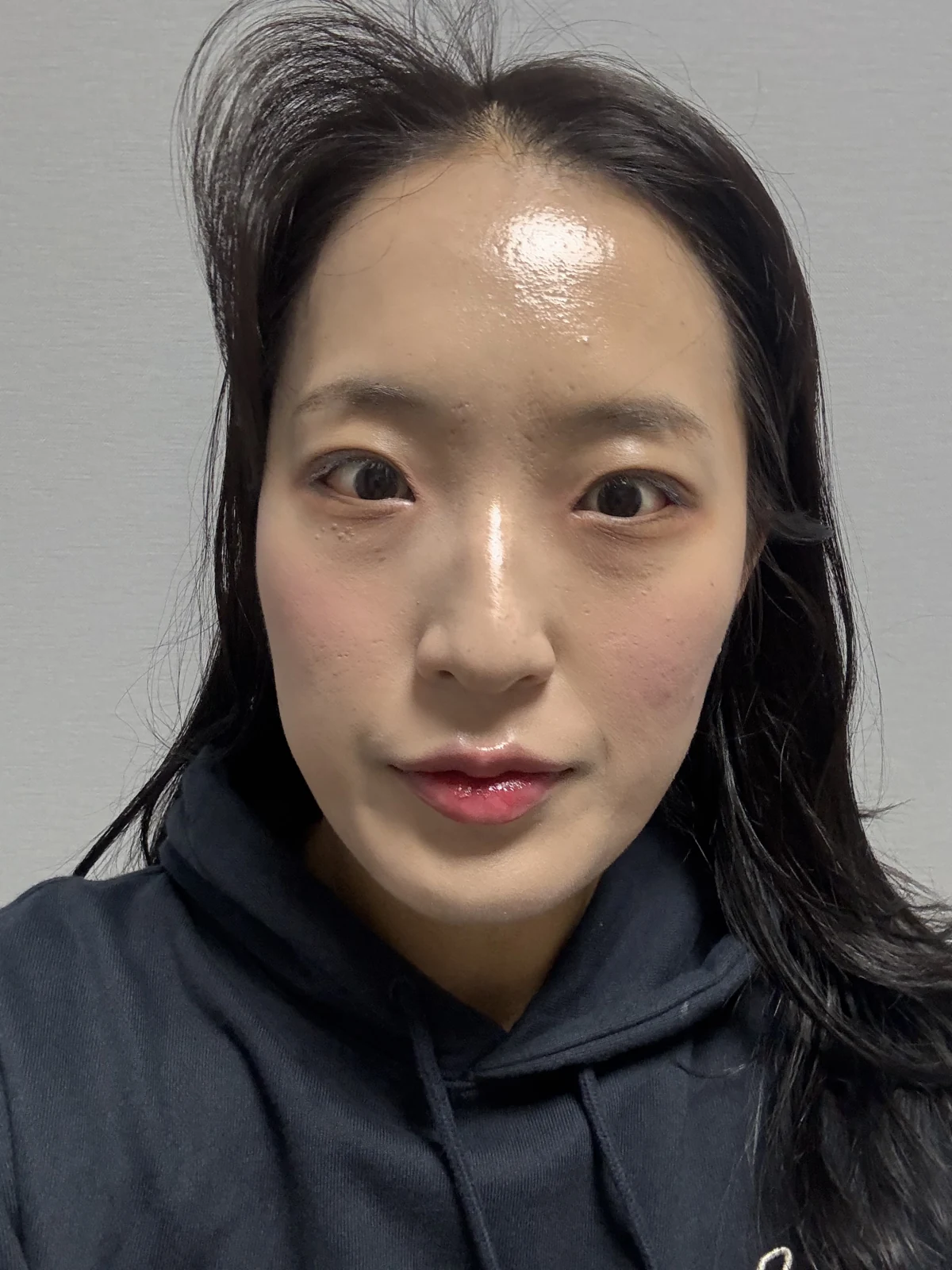 Inner and outer eye-corner surgery: a three-month photo diary · Case 037 at Answer Plastic Surgery. Front view — 3 weeks after surgery at Answer Plastic Surgery.