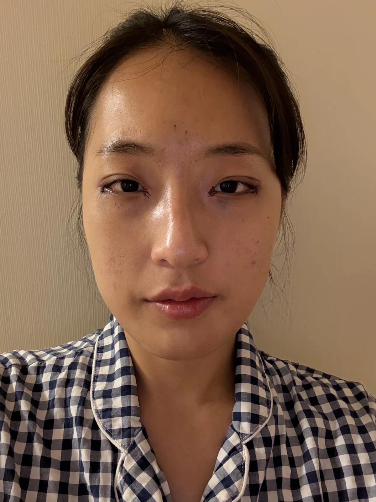 Inner and outer eye-corner surgery: a three-month photo diary · Case 037 at Answer Plastic Surgery. Front view — surgery day at Answer Plastic Surgery.