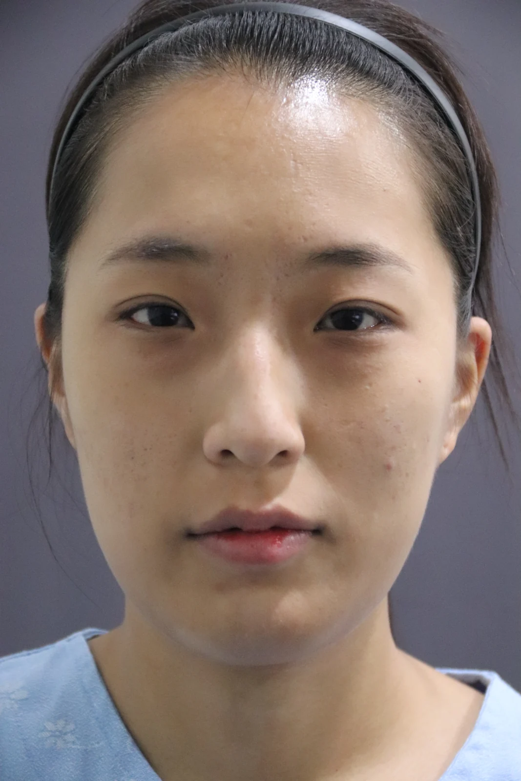 Inner and outer eye-corner surgery: a three-month photo diary · Case 037 at Answer Plastic Surgery. Front portrait — before at Answer Plastic Surgery.