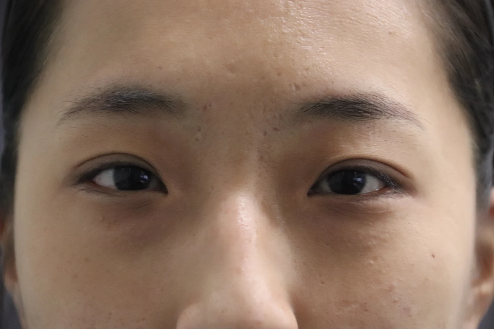 Inner and outer eye-corner surgery: a three-month photo diary · Case 037 at Answer Plastic Surgery. Close view of both eyes — before at Answer Plastic Surgery.