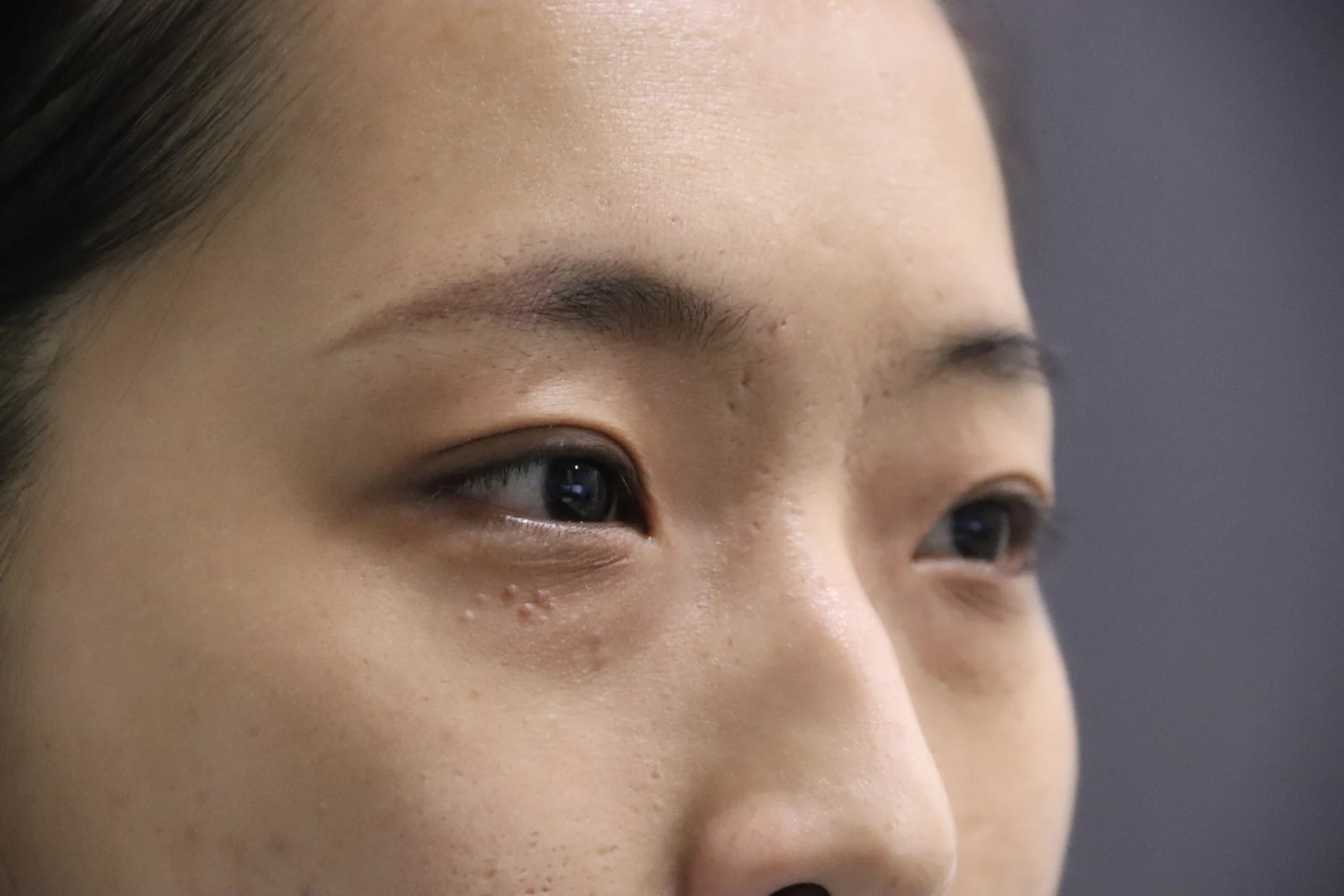 Inner and outer eye-corner surgery: a three-month photo diary · Case 037 at Answer Plastic Surgery. Oblique eye view — before at Answer Plastic Surgery.