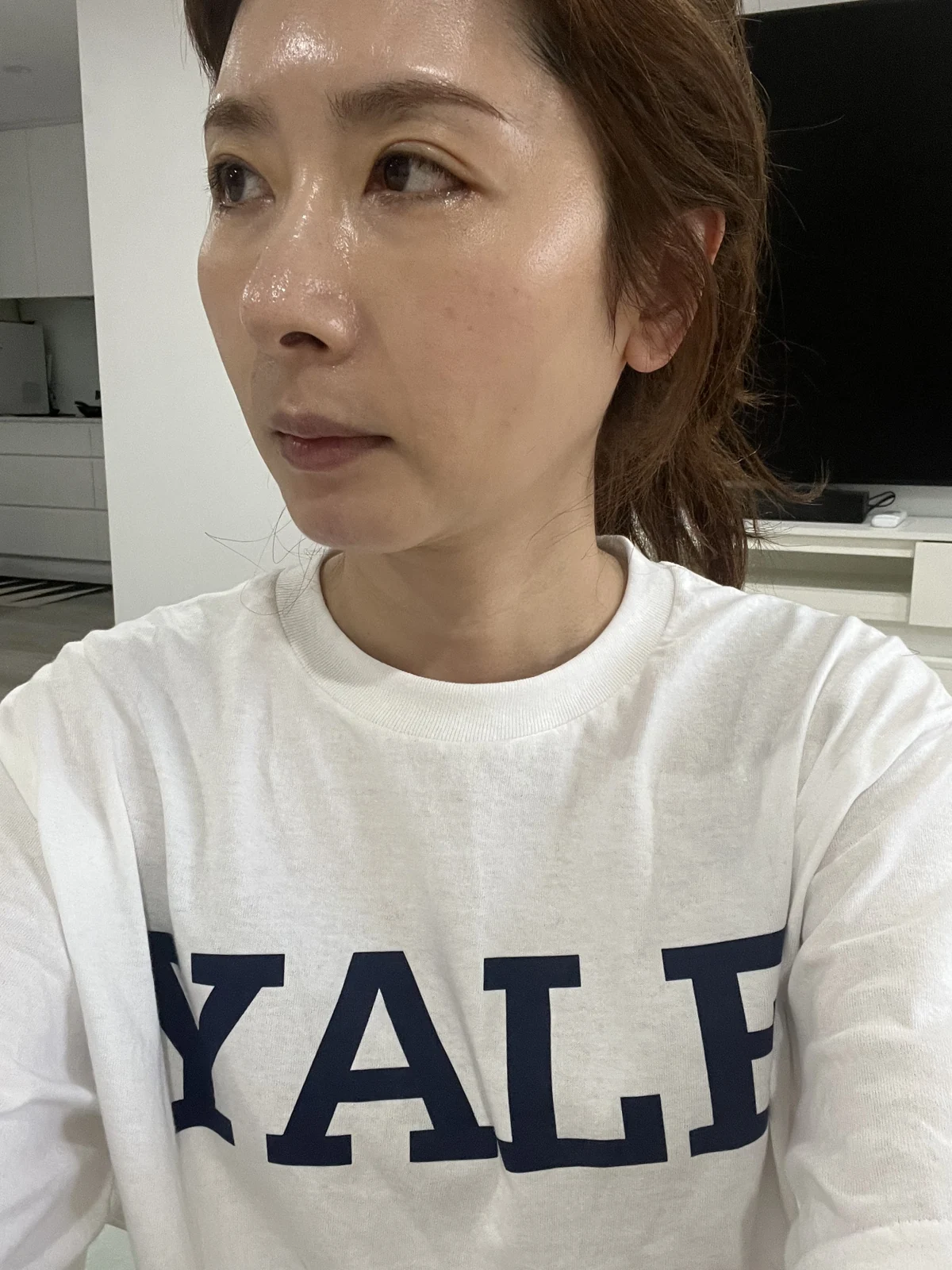 Wonder eye-corner surgery: swelling and appearance over three months · Case 038 at Answer Plastic Surgery. Oblique view — 1 month after surgery at Answer Plastic Surgery.