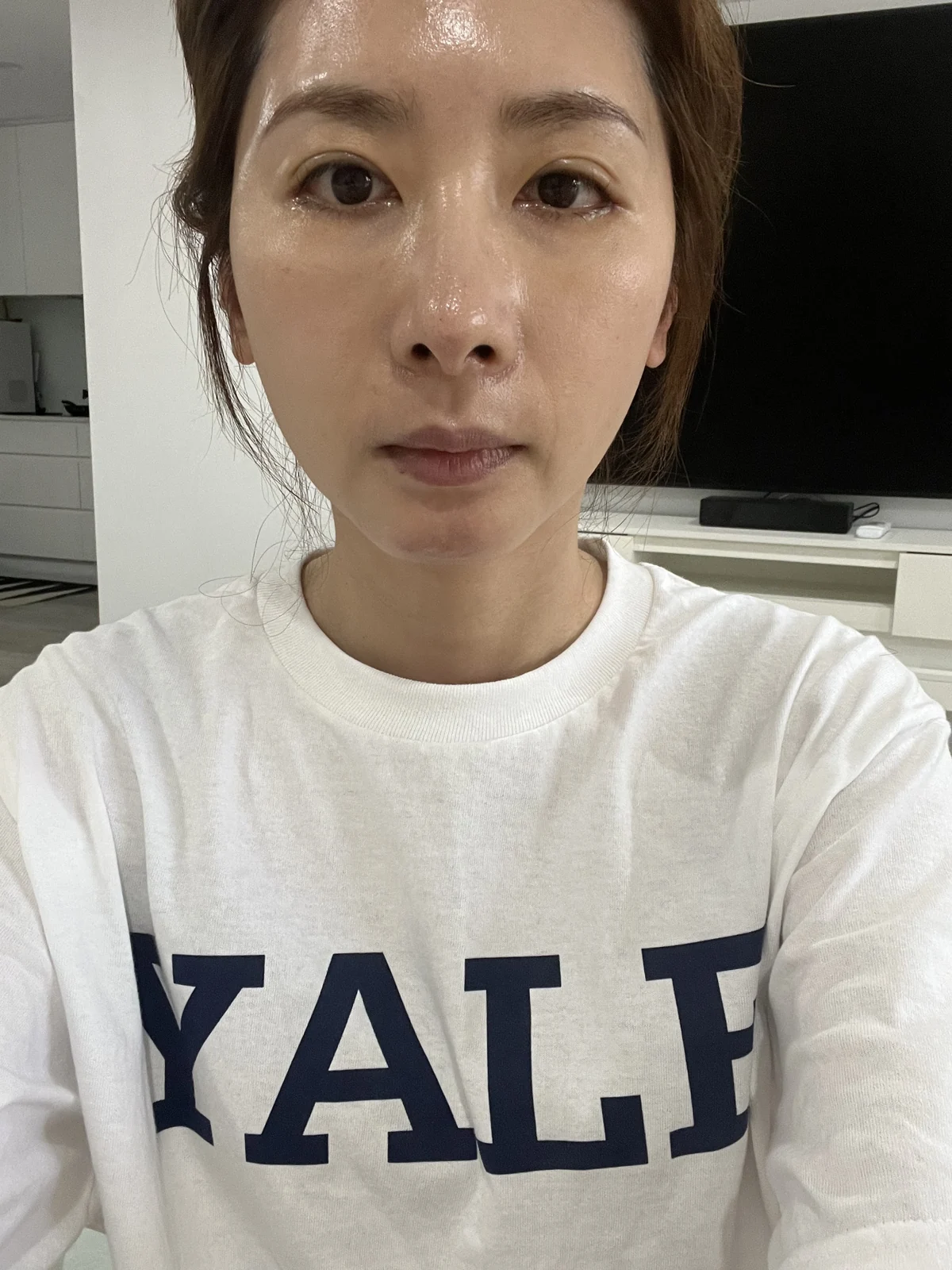 Wonder eye-corner surgery: swelling and appearance over three months · Case 038 at Answer Plastic Surgery. Front view — 1 month after surgery at Answer Plastic Surgery.