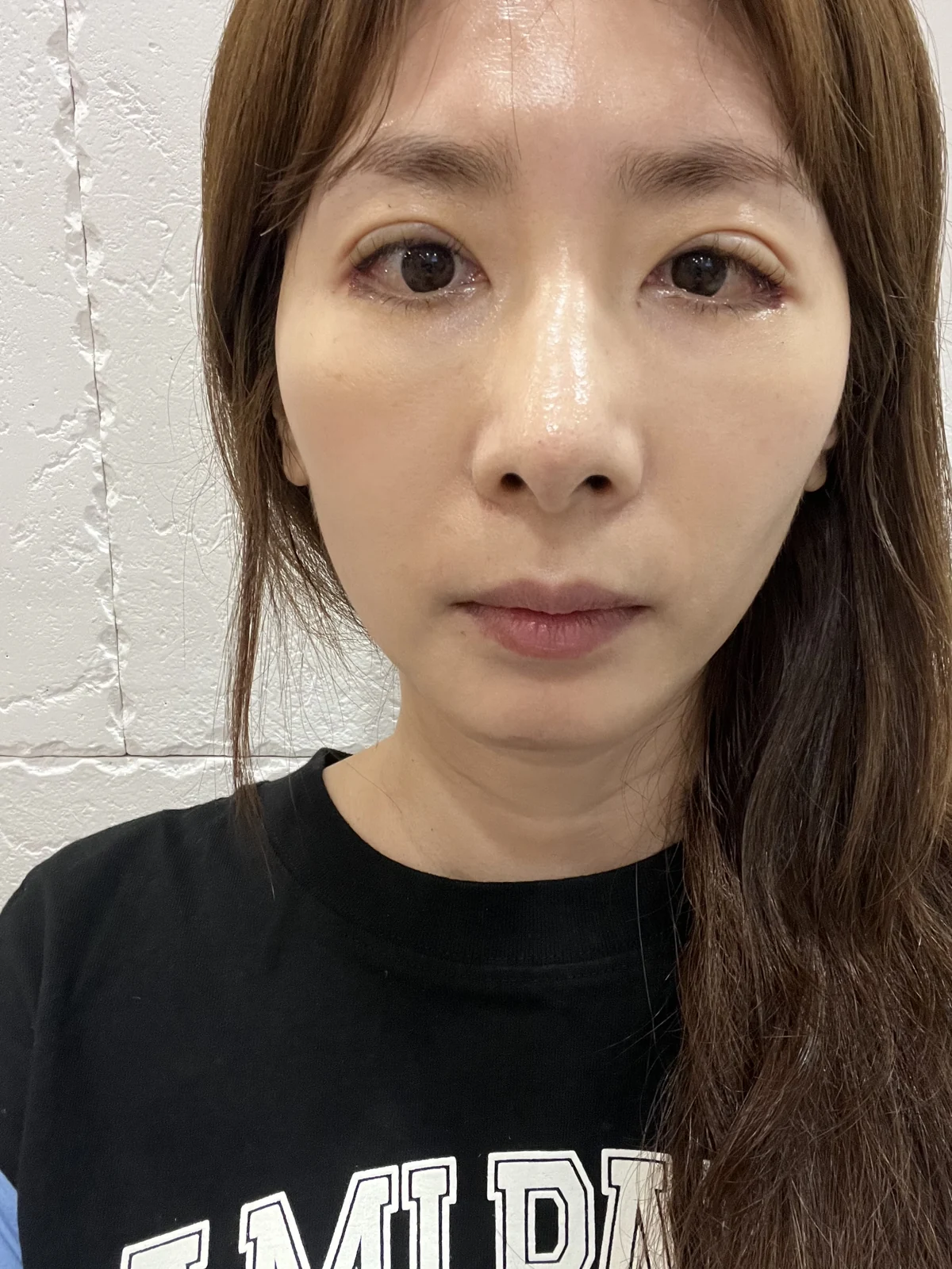 Wonder eye-corner surgery: swelling and appearance over three months · Case 038 at Answer Plastic Surgery. Front view — 1 week after surgery at Answer Plastic Surgery.