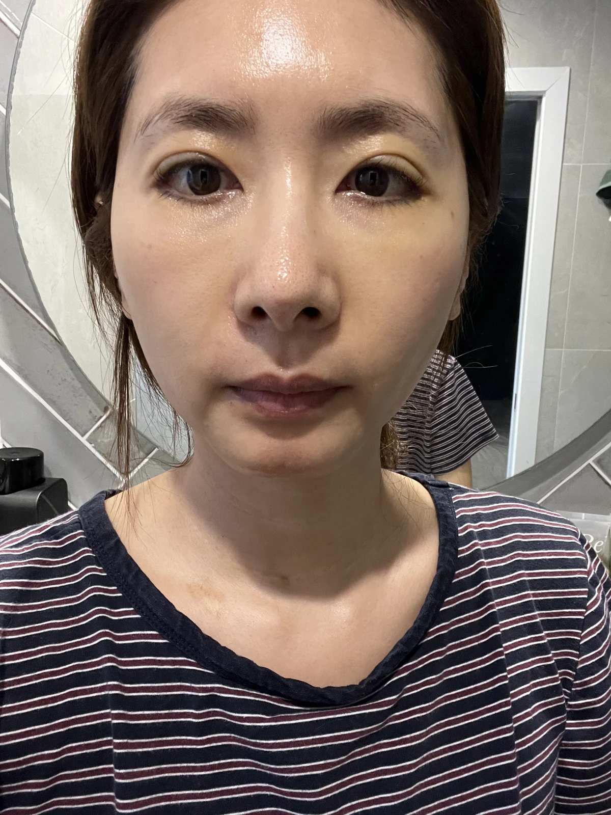 Wonder eye-corner surgery: swelling and appearance over three months · Case 038 at Answer Plastic Surgery. Additional front view — 1 week after surgery at Answer Plastic Surgery.