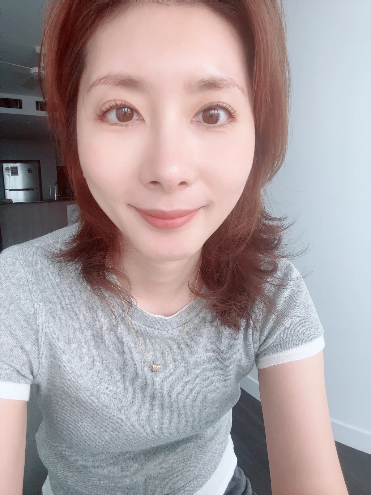 Wonder eye-corner surgery: swelling and appearance over three months · Case 038 at Answer Plastic Surgery. Front portrait — 3 months after surgery at Answer Plastic Surgery.