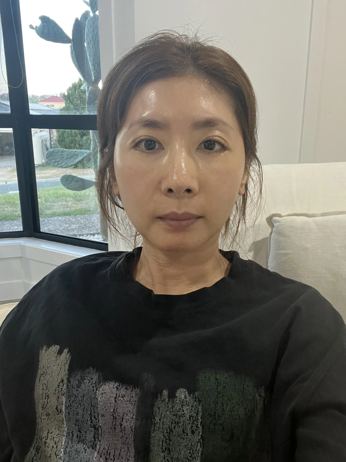 Wonder eye-corner surgery: swelling and appearance over three months · Case 038 at Answer Plastic Surgery. Front view — 3 weeks after surgery at Answer Plastic Surgery.