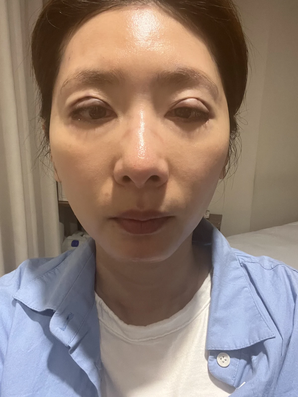 Wonder eye-corner surgery: swelling and appearance over three months · Case 038 at Answer Plastic Surgery. Front view — surgery day at Answer Plastic Surgery.
