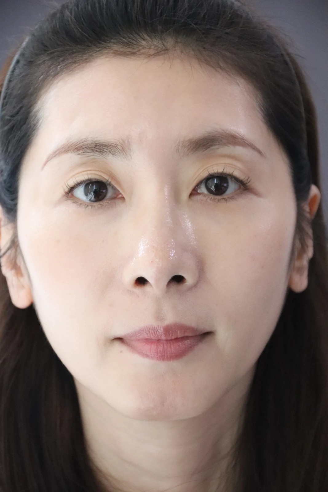 Wonder eye-corner surgery: swelling and appearance over three months · Case 038 at Answer Plastic Surgery. Front portrait — before at Answer Plastic Surgery.