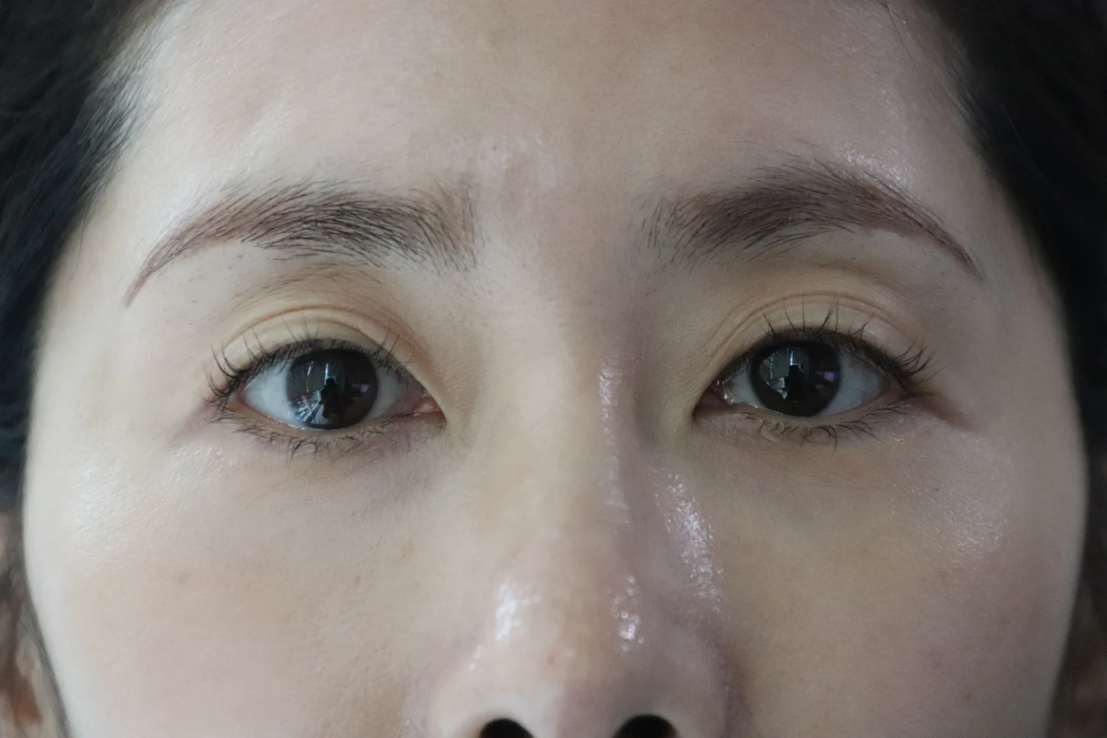Wonder eye-corner surgery: swelling and appearance over three months · Case 038 at Answer Plastic Surgery. Close view of both eyes — before at Answer Plastic Surgery.