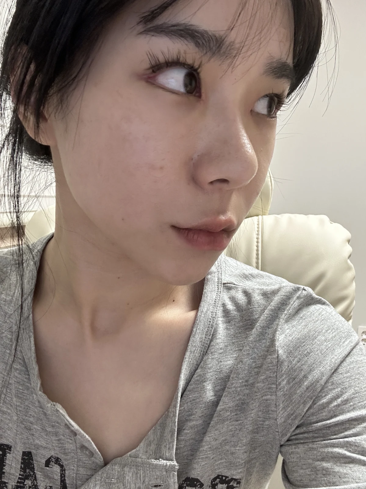 Inner-corner and Wonder eye surgery: the first two weeks · Case 039 at Answer Plastic Surgery. Oblique view — 1 week after surgery at Answer Plastic Surgery.