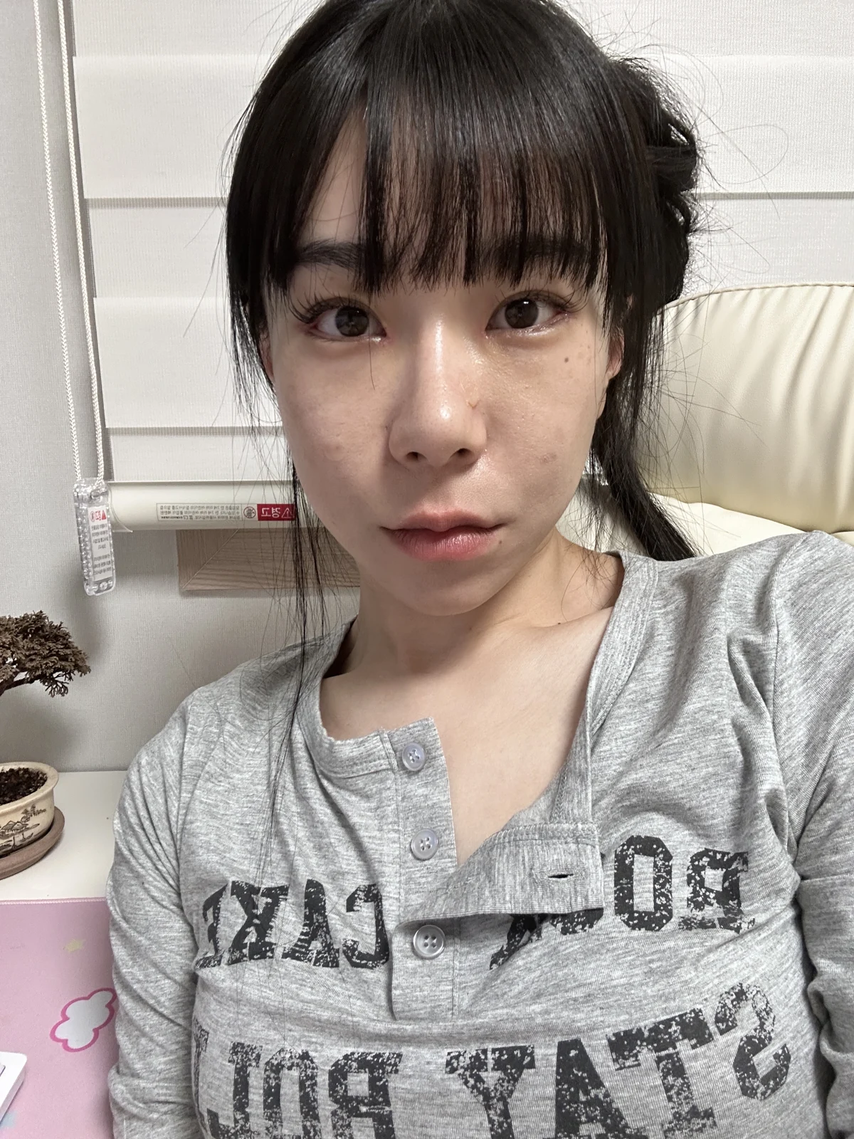 Inner-corner and Wonder eye surgery: the first two weeks · Case 039 at Answer Plastic Surgery. Front view — 1 week after surgery at Answer Plastic Surgery.