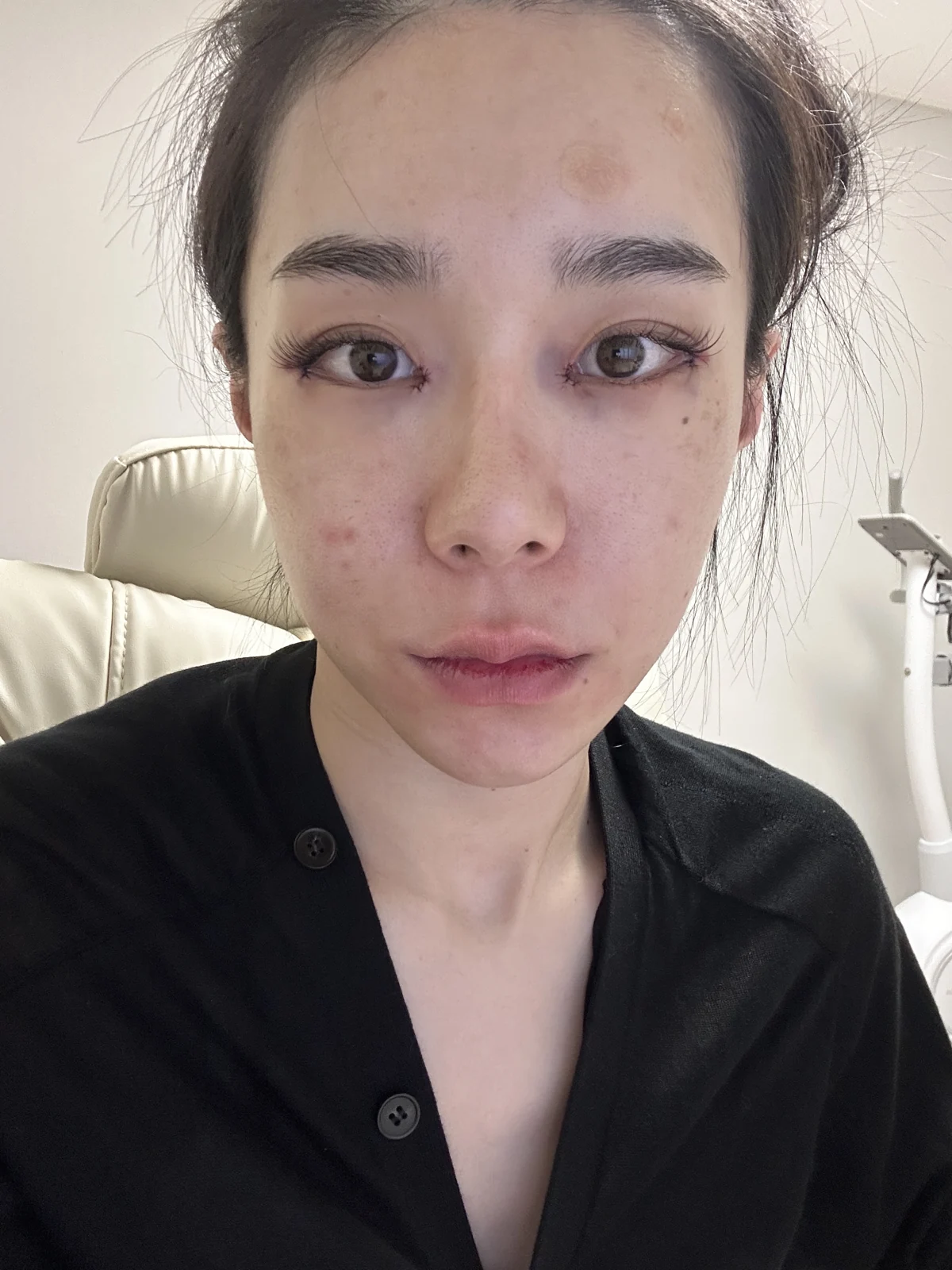 Inner-corner and Wonder eye surgery: the first two weeks · Case 039 at Answer Plastic Surgery. Front view — surgery day at Answer Plastic Surgery.