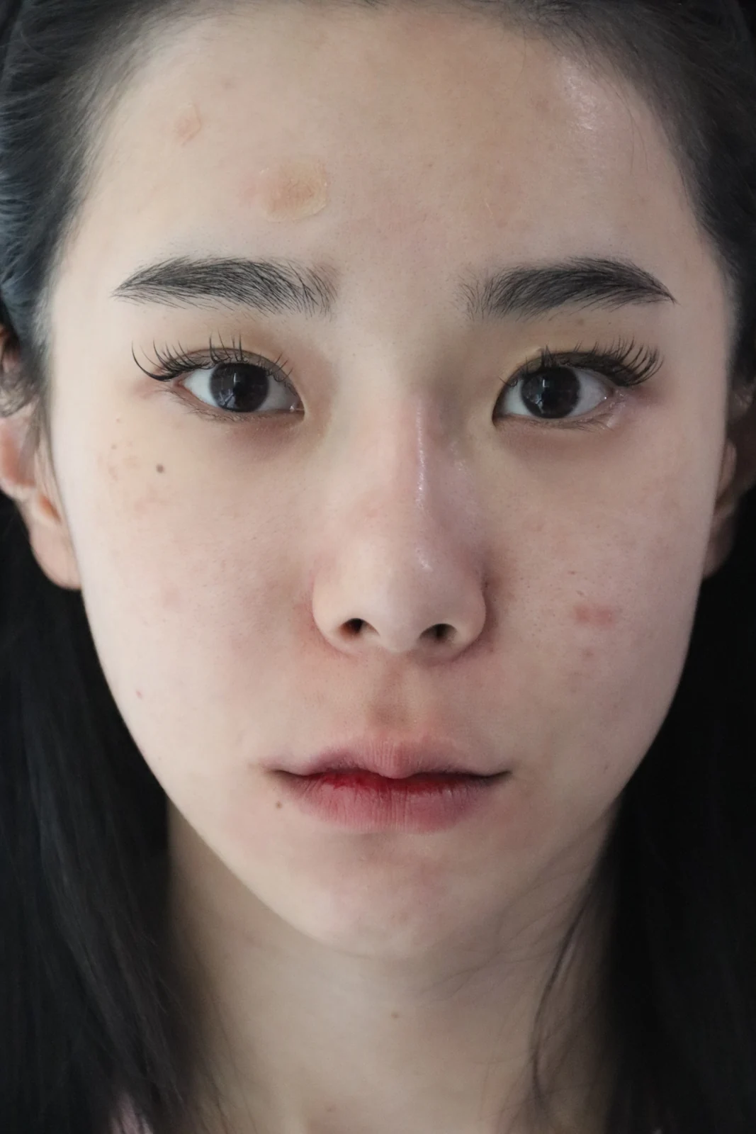 Inner-corner and Wonder eye surgery: the first two weeks · Case 039 at Answer Plastic Surgery. Front portrait — before at Answer Plastic Surgery.