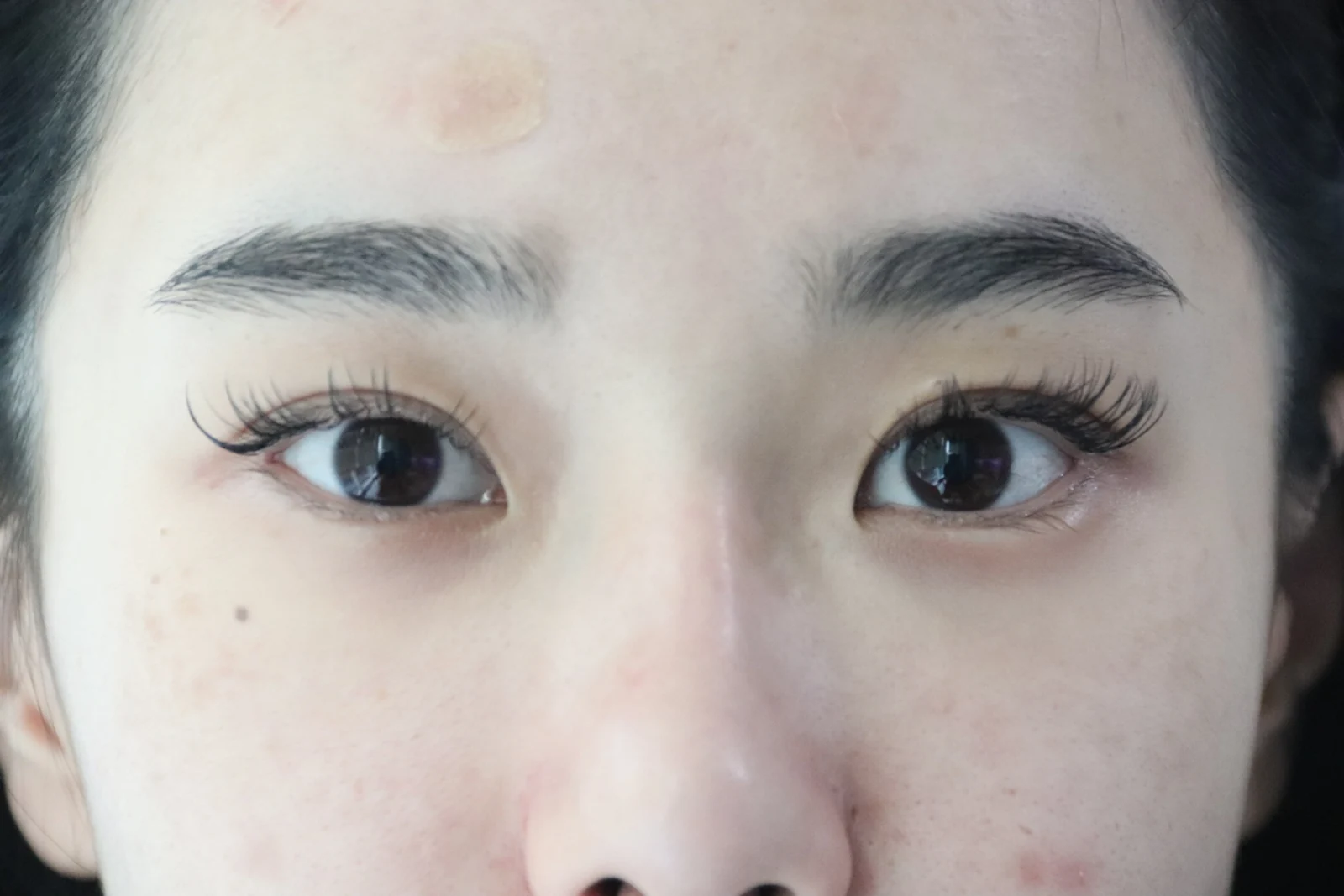 Inner-corner and Wonder eye surgery: the first two weeks · Case 039 at Answer Plastic Surgery. Close view of both eyes — before at Answer Plastic Surgery.