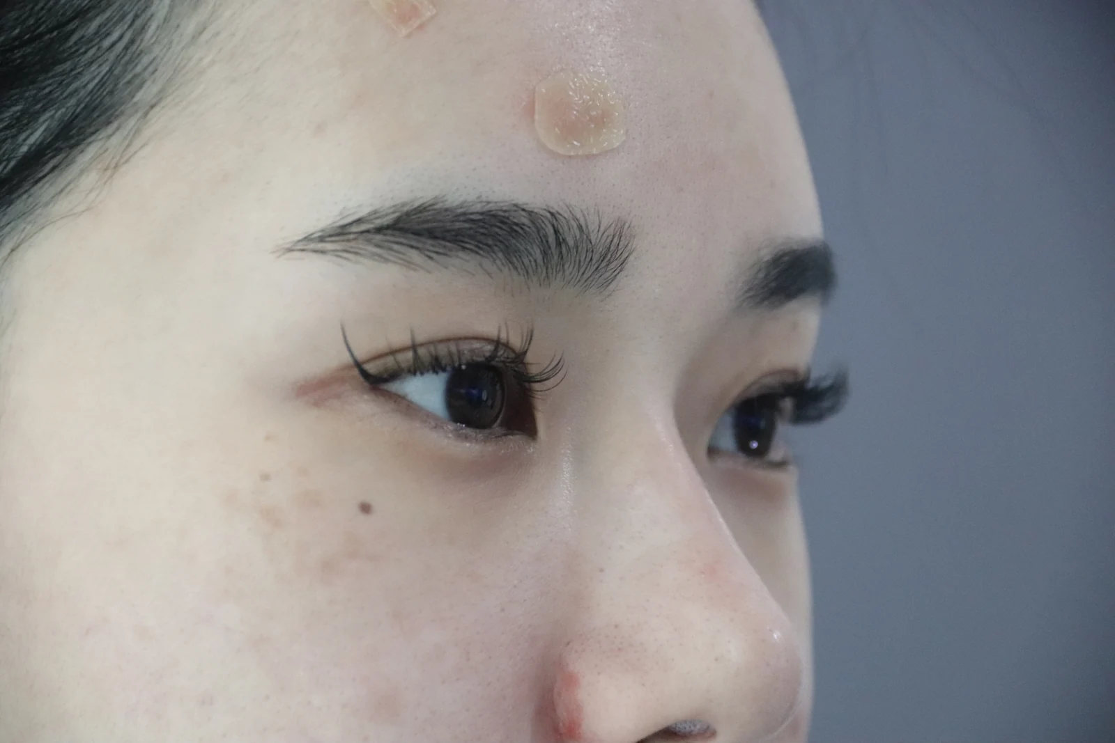 Inner-corner and Wonder eye surgery: the first two weeks · Case 039 at Answer Plastic Surgery. Oblique eye view — before at Answer Plastic Surgery.