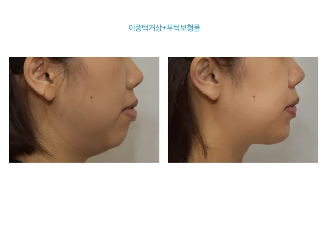 Chin implant and under-chin lift at B:ON Plastic Surgery. B:ON Plastic Surgery: Chin implant and under-chin lift. Side profile views, before on the left and after on the right. Follow-up: not supplied.
