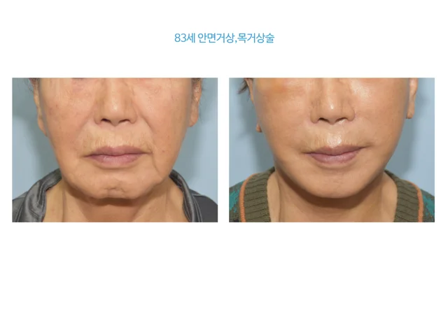 Face and neck lift: lower-face comparison at B:ON Plastic Surgery. B:ON Plastic Surgery: Face and neck lift: lower-face comparison. Lower-face front views, before on the left and after on the right. Follow-up: not supplied.