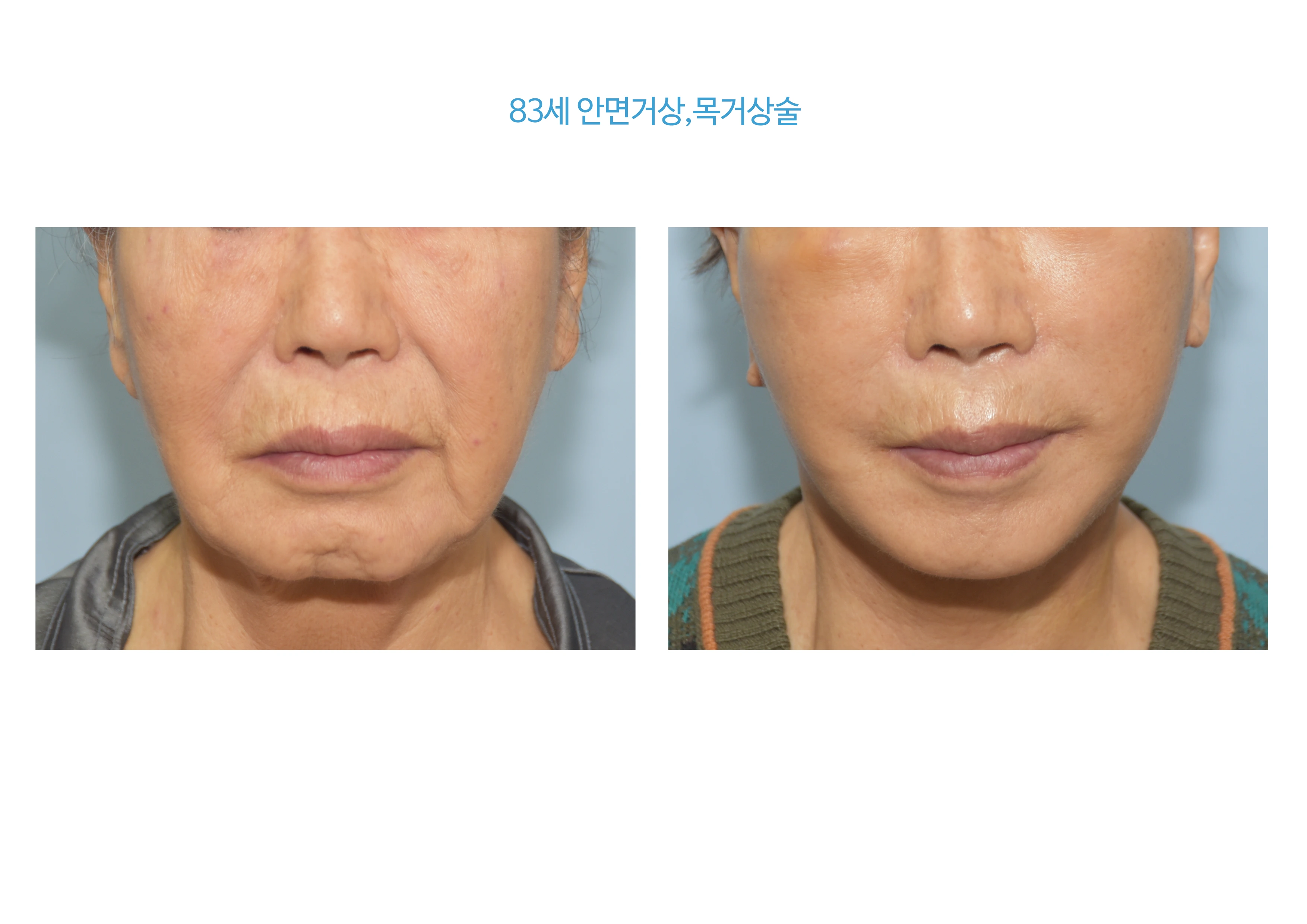 Face and neck lift: lower-face comparison at B:ON Plastic Surgery. B:ON Plastic Surgery: Face and neck lift: lower-face comparison. Lower-face front views, before on the left and after on the right. Follow-up: not supplied.