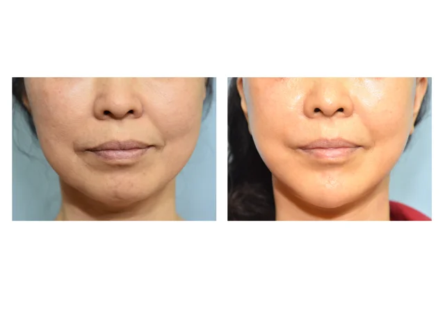 Face and neck lift with lower-eyelid surgery at B:ON Plastic Surgery. B:ON Plastic Surgery: Face and neck lift with lower-eyelid surgery. Front views, before on the left and after on the right. Follow-up: not separately labelled.