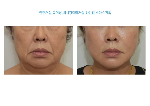 Face, neck and forehead lifting with lower-eyelid surgery at B:ON Plastic Surgery. B:ON Plastic Surgery: Face, neck and forehead lifting with lower-eyelid surgery. Front views, before on the left and after on the right. Follow-up: not supplied.