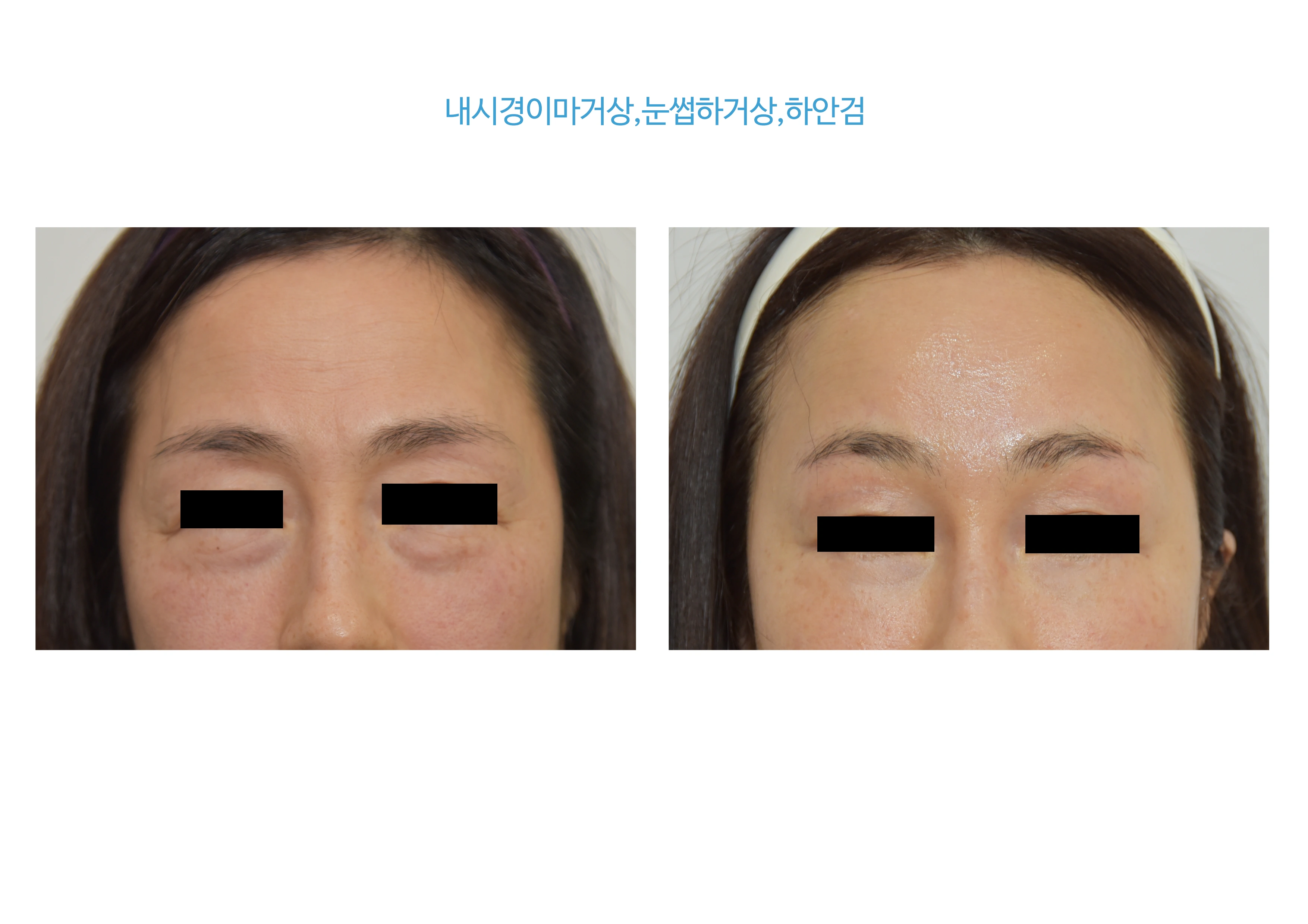 Forehead and brow lifting with lower-eyelid surgery at B:ON Plastic Surgery. B:ON Plastic Surgery: Forehead and brow lifting with lower-eyelid surgery. Upper-face close-up views, before on the left and after on the right. Follow-up: not supplied.