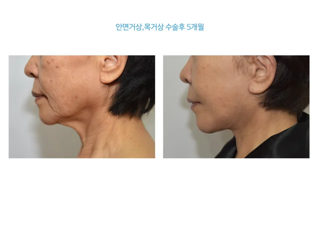 Face and neck lift: five-month profile at B:ON Plastic Surgery. B:ON Plastic Surgery: Face and neck lift: five-month profile. Side profile views, before on the left and after on the right. Follow-up: 5 months.