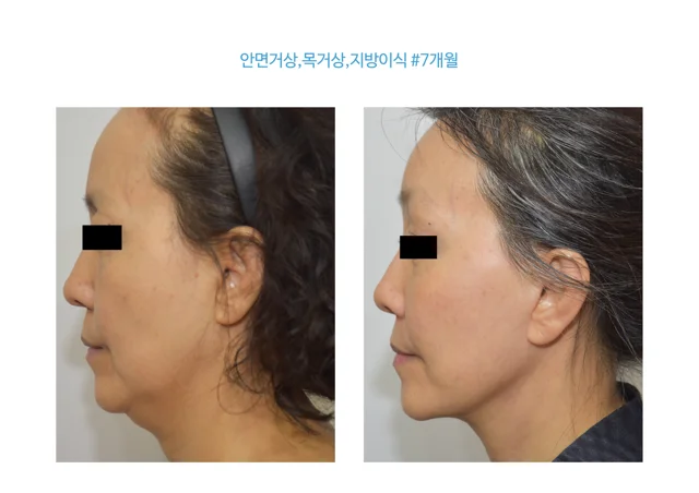 Face and neck lift with fat grafting: seven months at B:ON Plastic Surgery. B:ON Plastic Surgery: Face and neck lift with fat grafting: seven months. Angled profile views, before on the left and after on the right. Follow-up: 7 months.