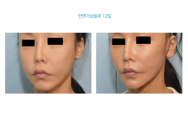 Facelift: twelve-day recovery view at B:ON Plastic Surgery. B:ON Plastic Surgery: Facelift: twelve-day recovery view. Angled views, before on the left and after on the right. Follow-up: 12 days.