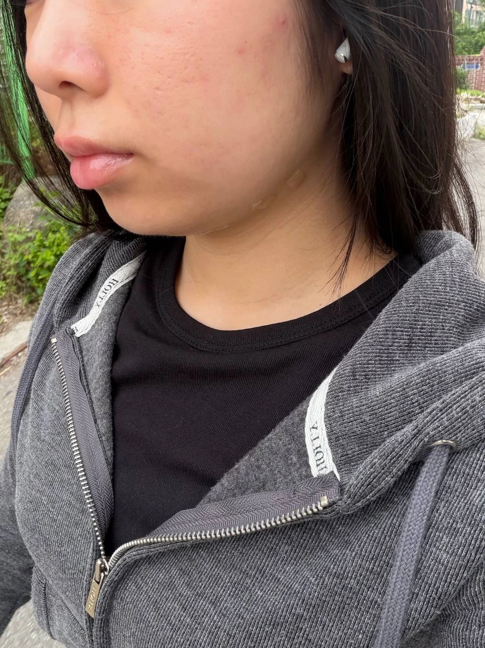 Aptos lifting — under the chin at BLS Clinic Myeongdong. Before treatment. Angled view of the lower face and jawline.