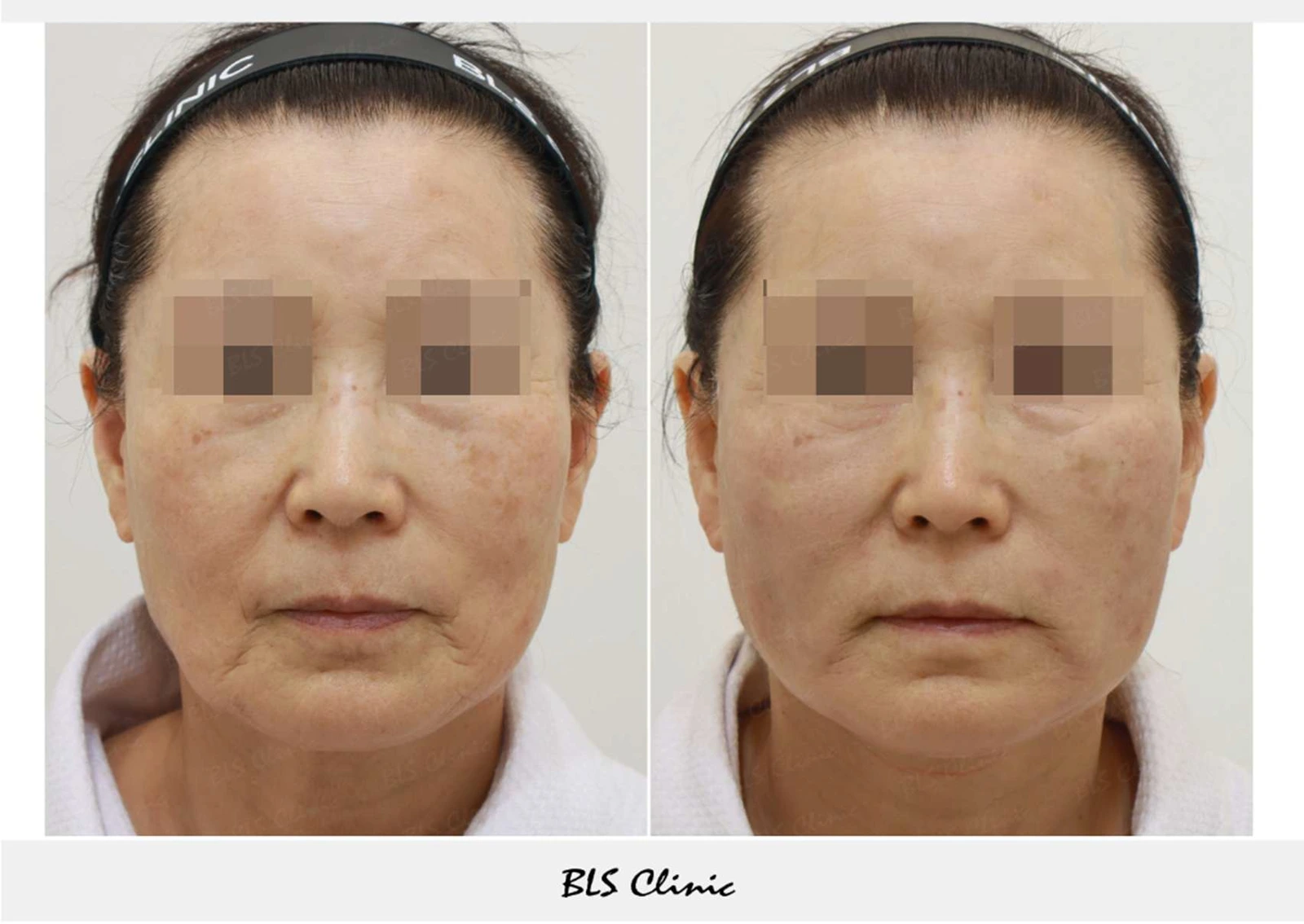 Thread lifting of the cheeks and under the chin at BLS Clinic Myeongdong. Front view of the cheeks and lower facial outline. Before on the left; after on the right.