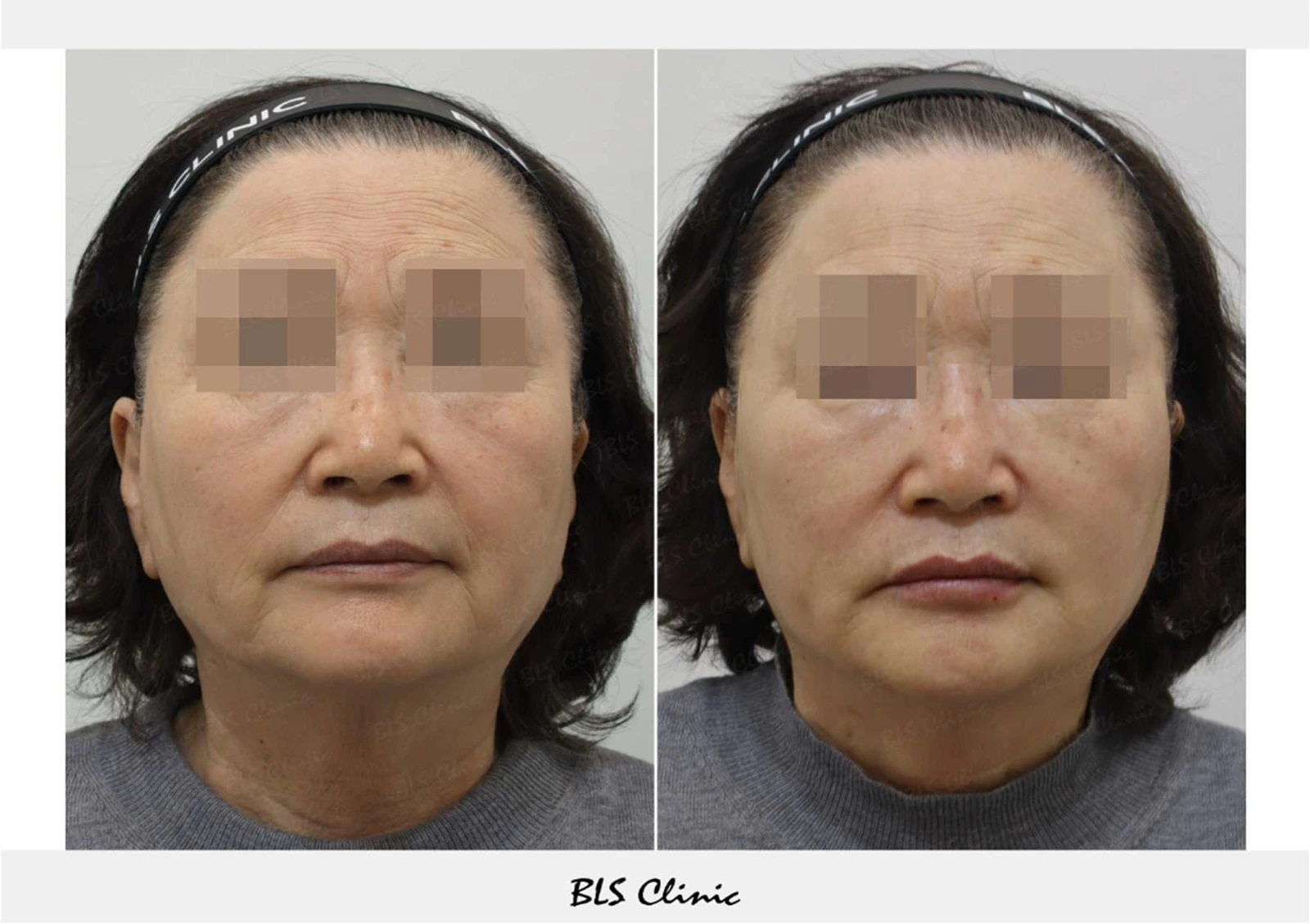 Thread lifting — front and side views at BLS Clinic Myeongdong. Front view of the lower cheeks and jaw. Before on the left; after on the right.